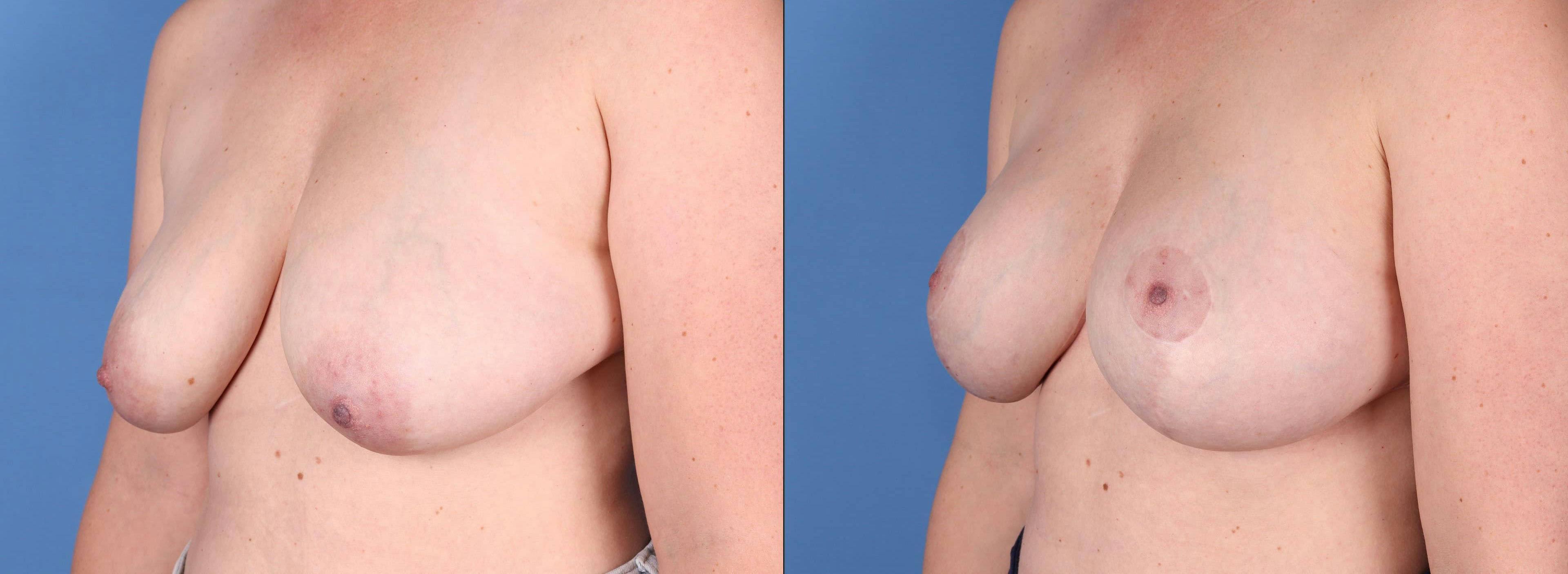 Breast Lift with Augmentation Before & After Gallery - Patient 144211596 - Image 2