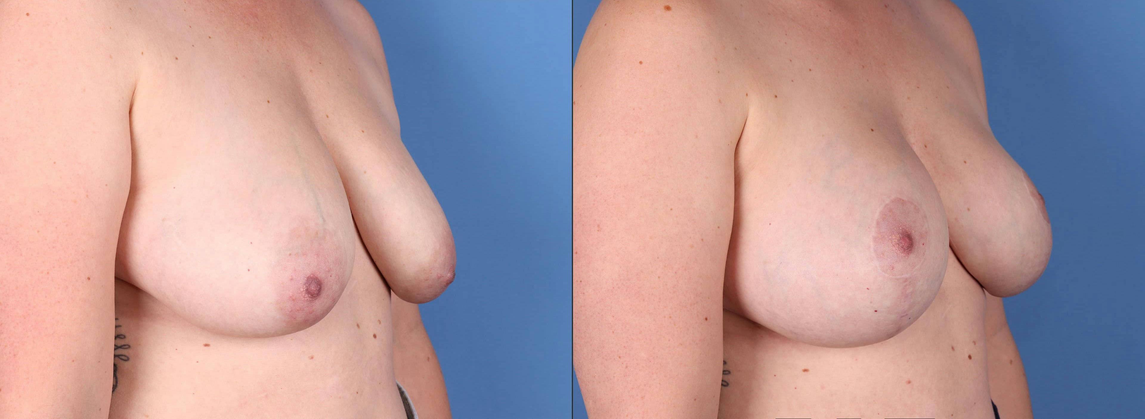 Breast Lift with Augmentation Before & After Gallery - Patient 144211596 - Image 5