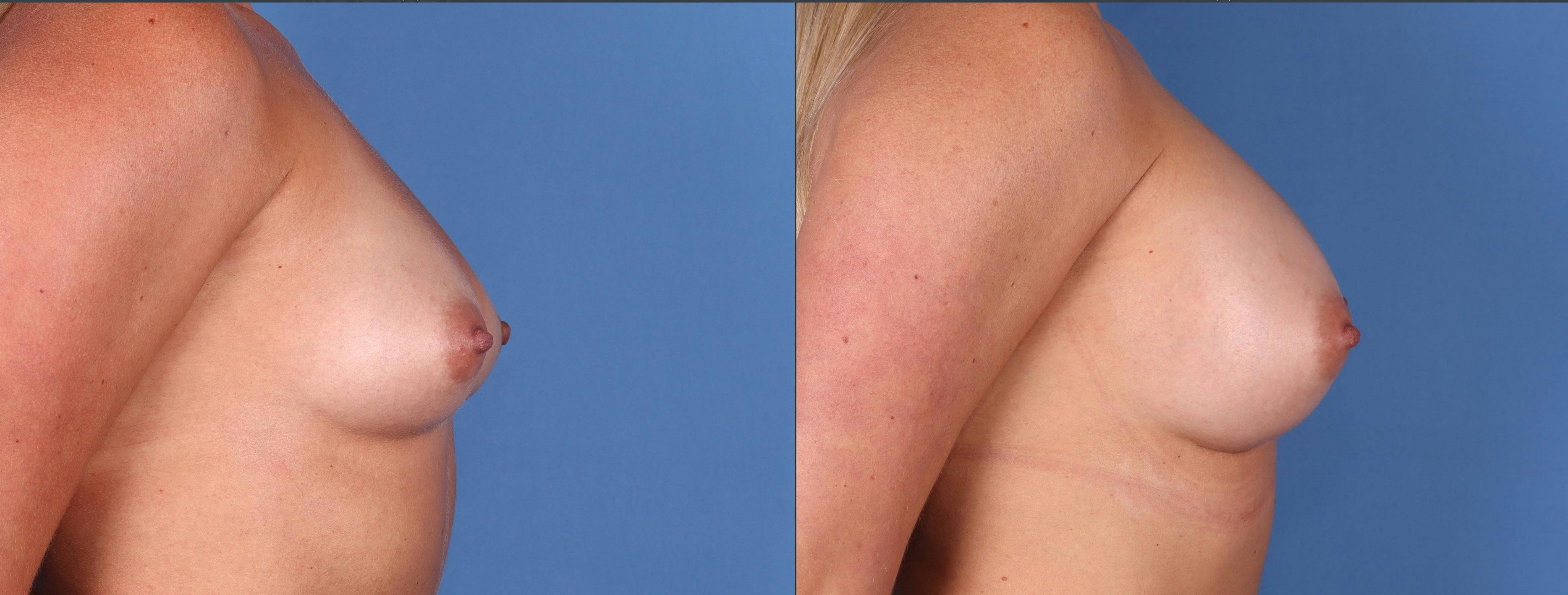 Breast Augmentation Before & After Gallery - Patient 144296424 - Image 3
