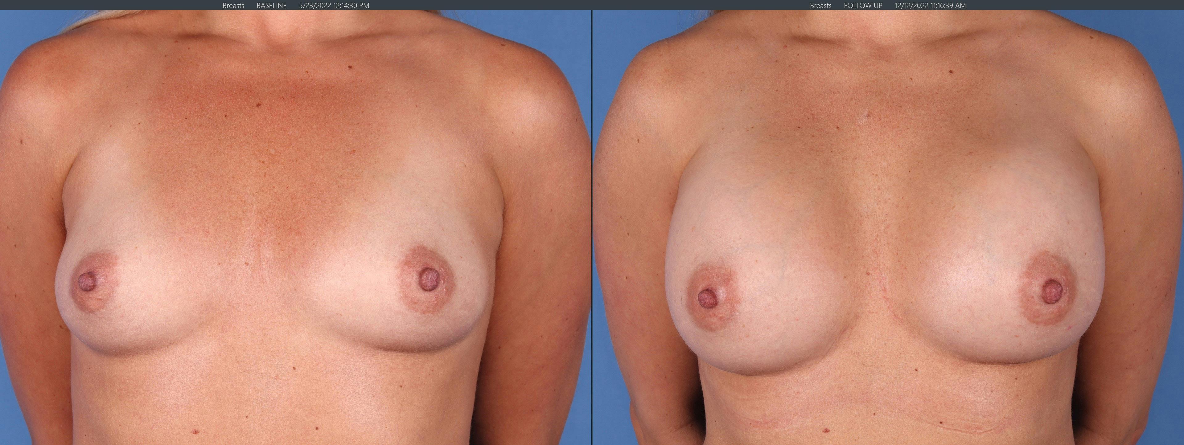 Breast Augmentation Before & After Gallery - Patient 144296424 - Image 1