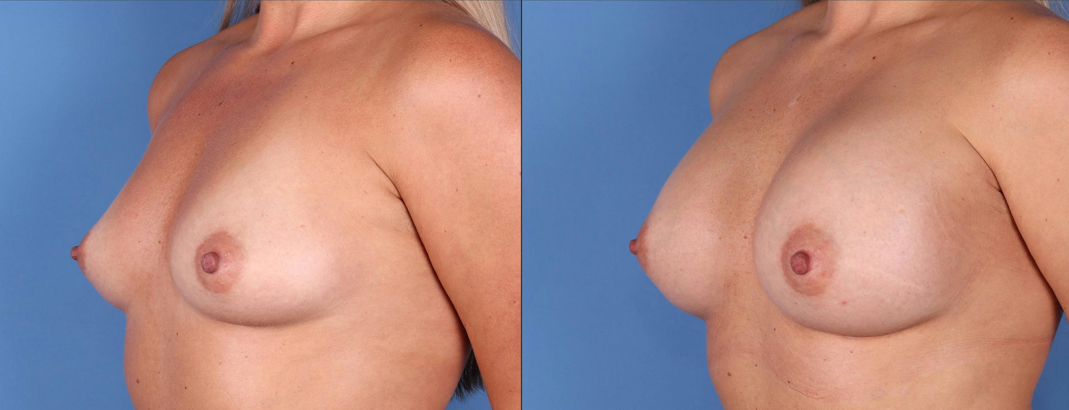 Breast Augmentation Before & After Gallery - Patient 144296424 - Image 4