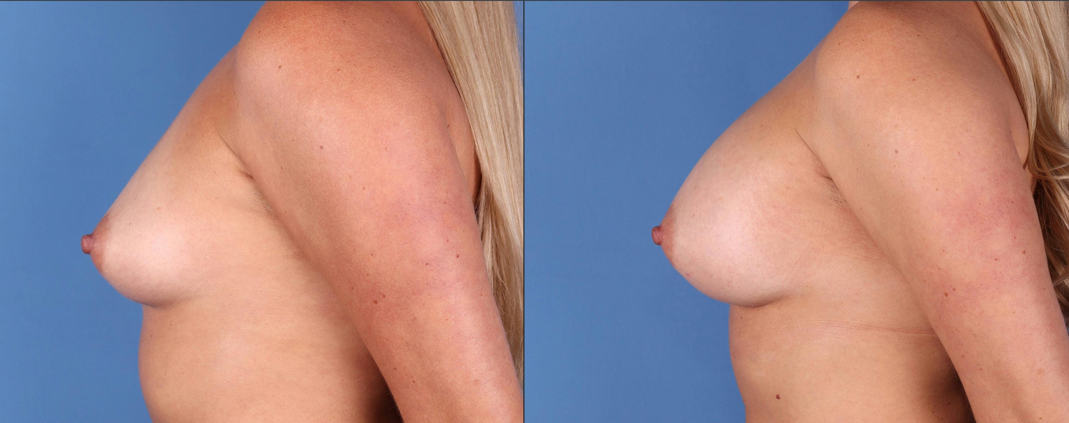 Breast Augmentation Before & After Gallery - Patient 144296424 - Image 5