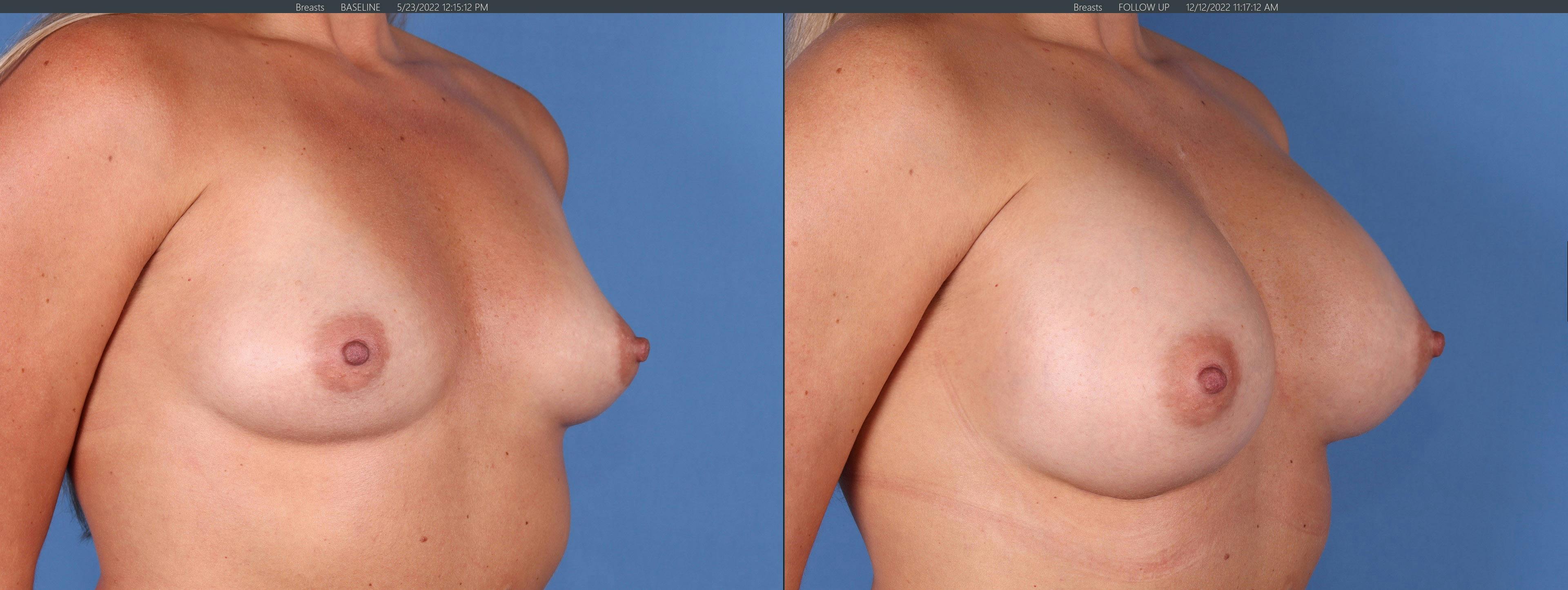Breast Augmentation Before & After Gallery - Patient 144296424 - Image 2