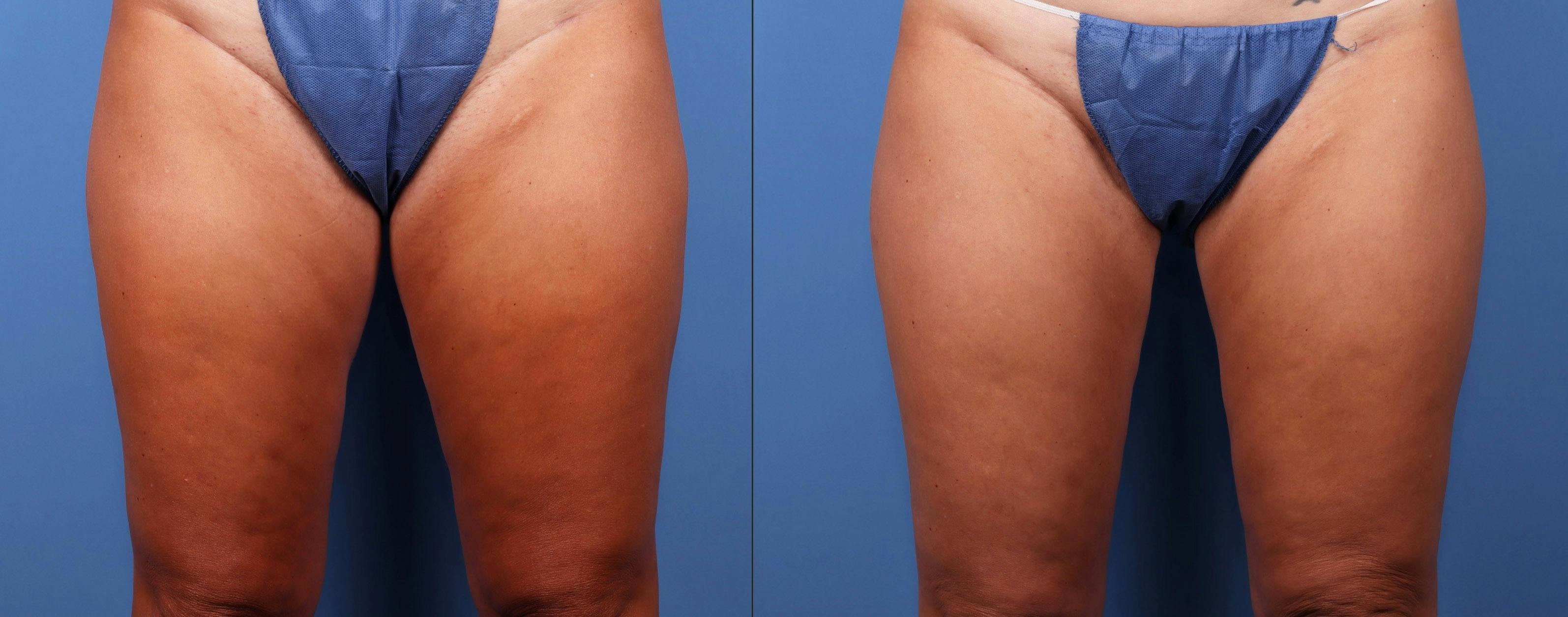 Thighs Before & After Gallery - Patient 149385424 - Image 1