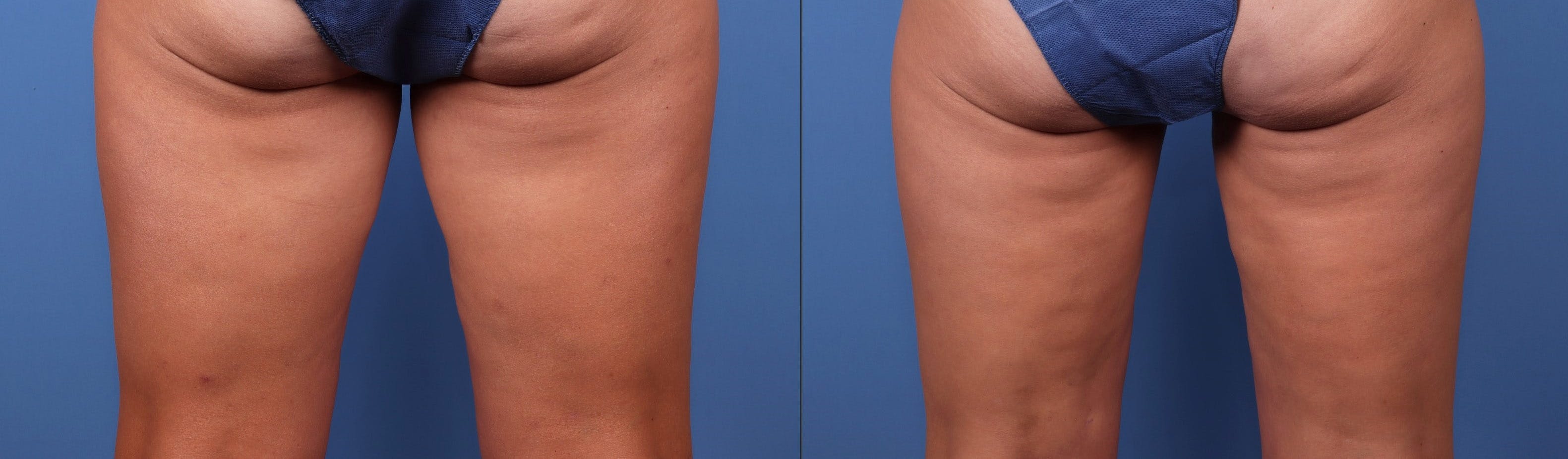 Thighs Before & After Gallery - Patient 149385424 - Image 2