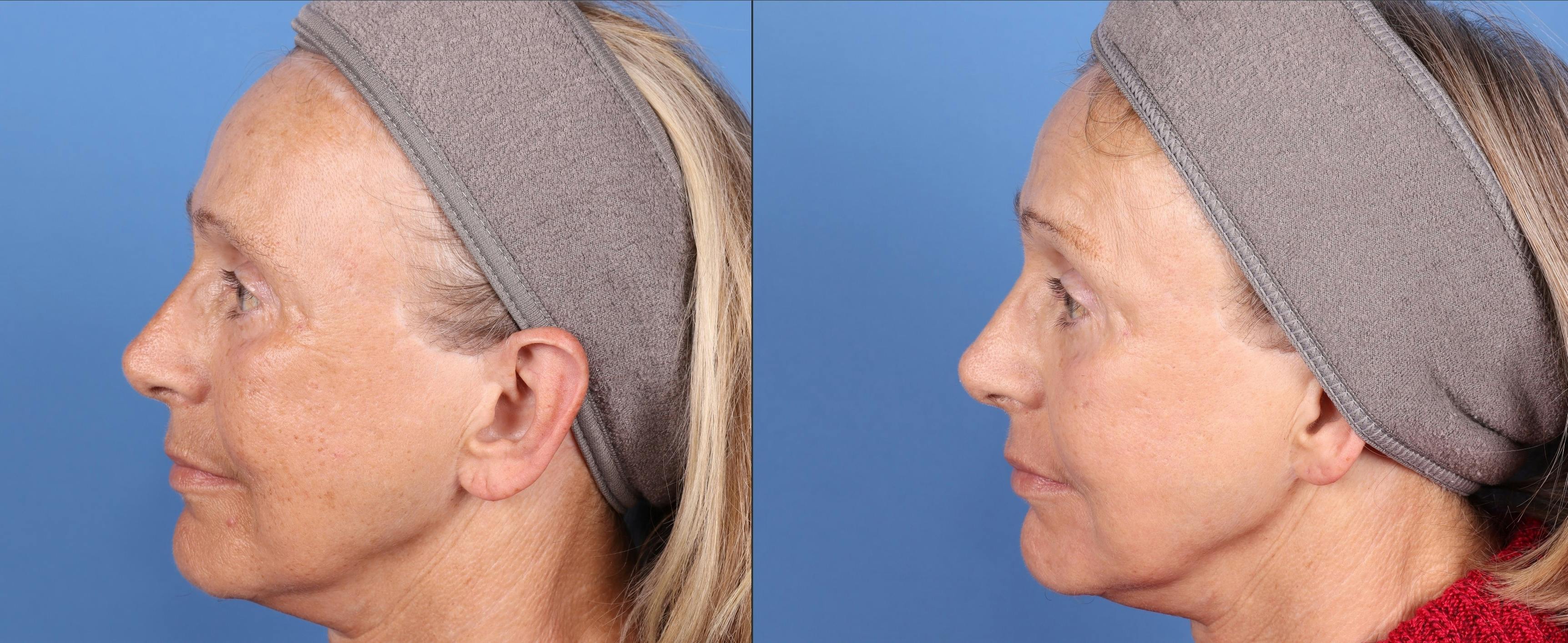 Contour TRL Laser Before & After Gallery - Patient 144404887 - Image 3