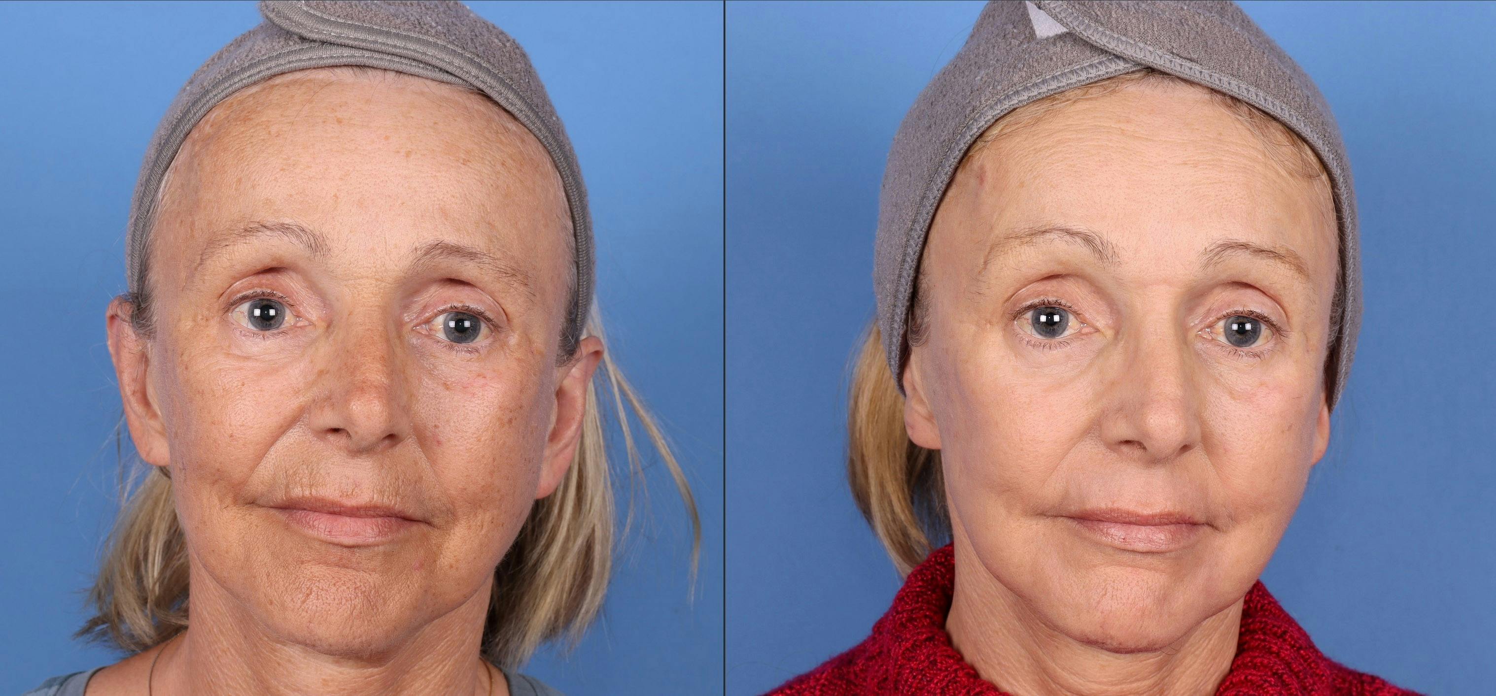 Contour TRL Laser Before & After Gallery - Patient 144404887 - Image 1