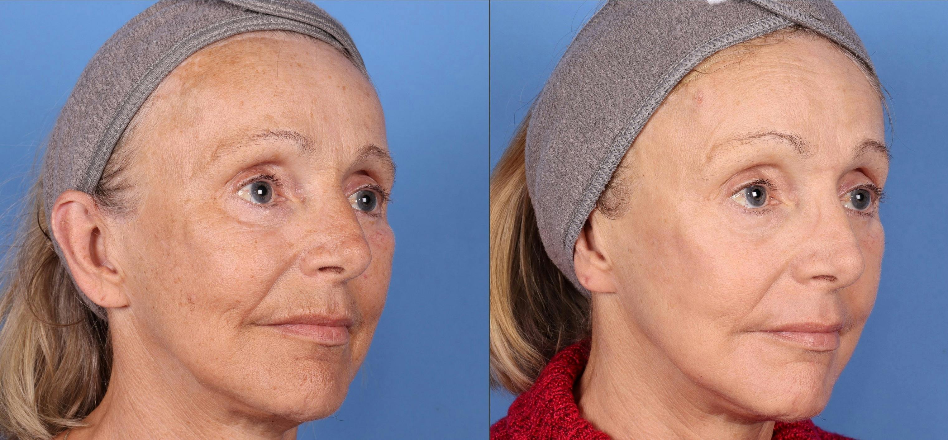 Contour TRL Laser Before & After Gallery - Patient 144404887 - Image 2