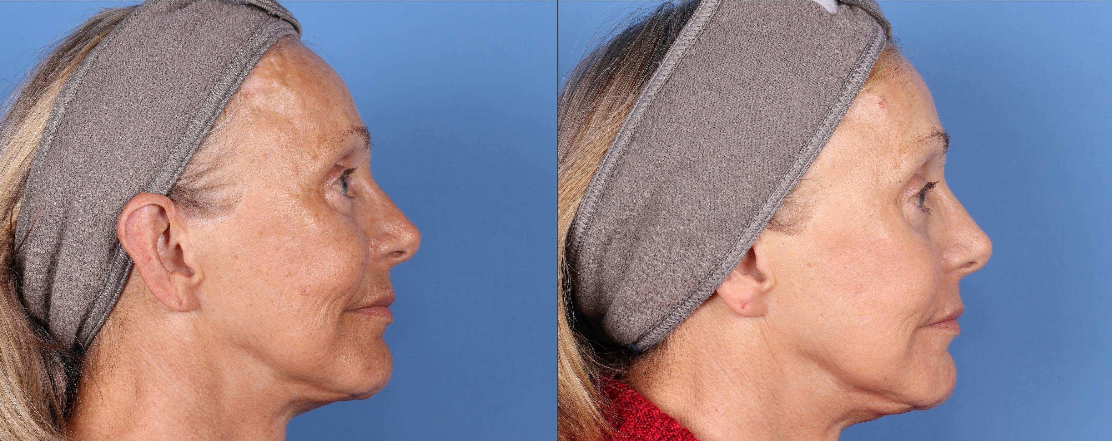 Contour TRL Laser Before & After Gallery - Patient 144404887 - Image 4