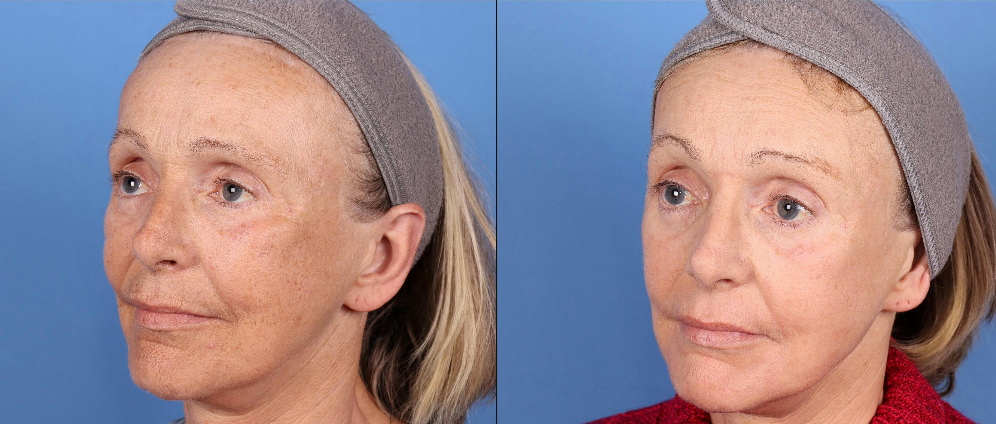 Contour TRL Laser Before & After Gallery - Patient 144404887 - Image 5