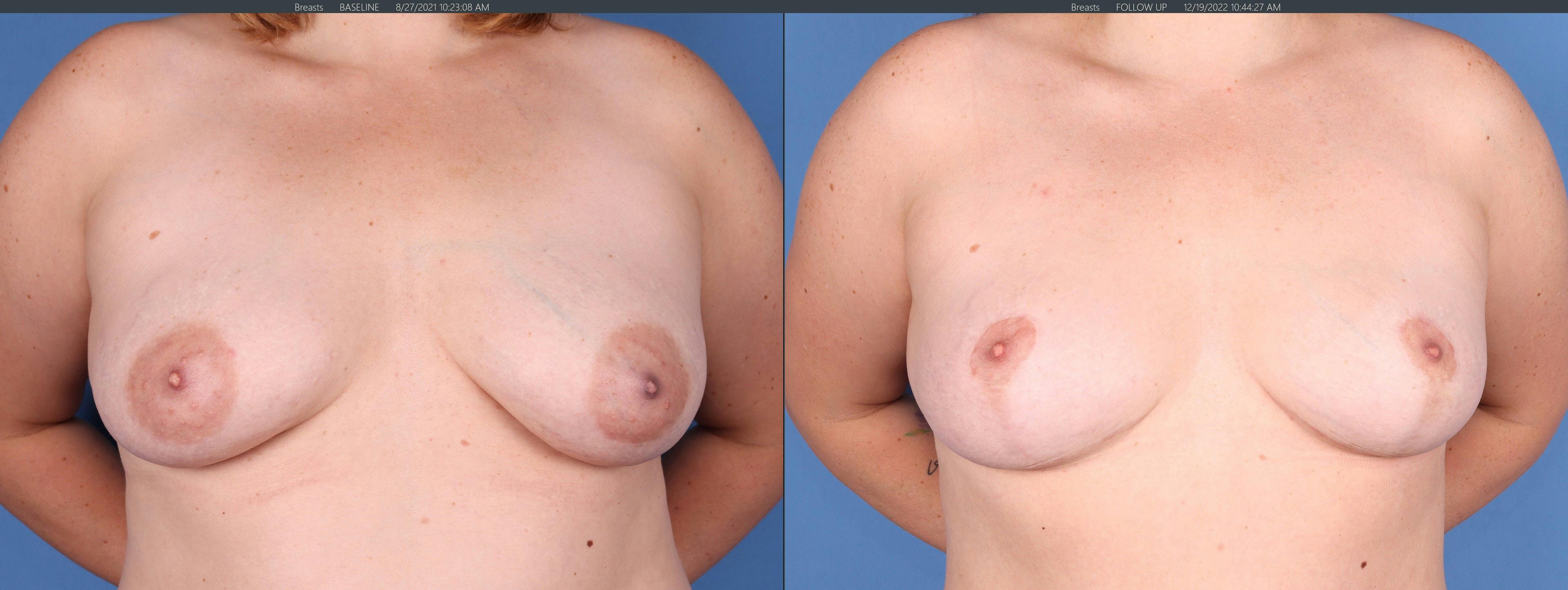 Breast Lift Before & After Gallery - Patient 144405666 - Image 1