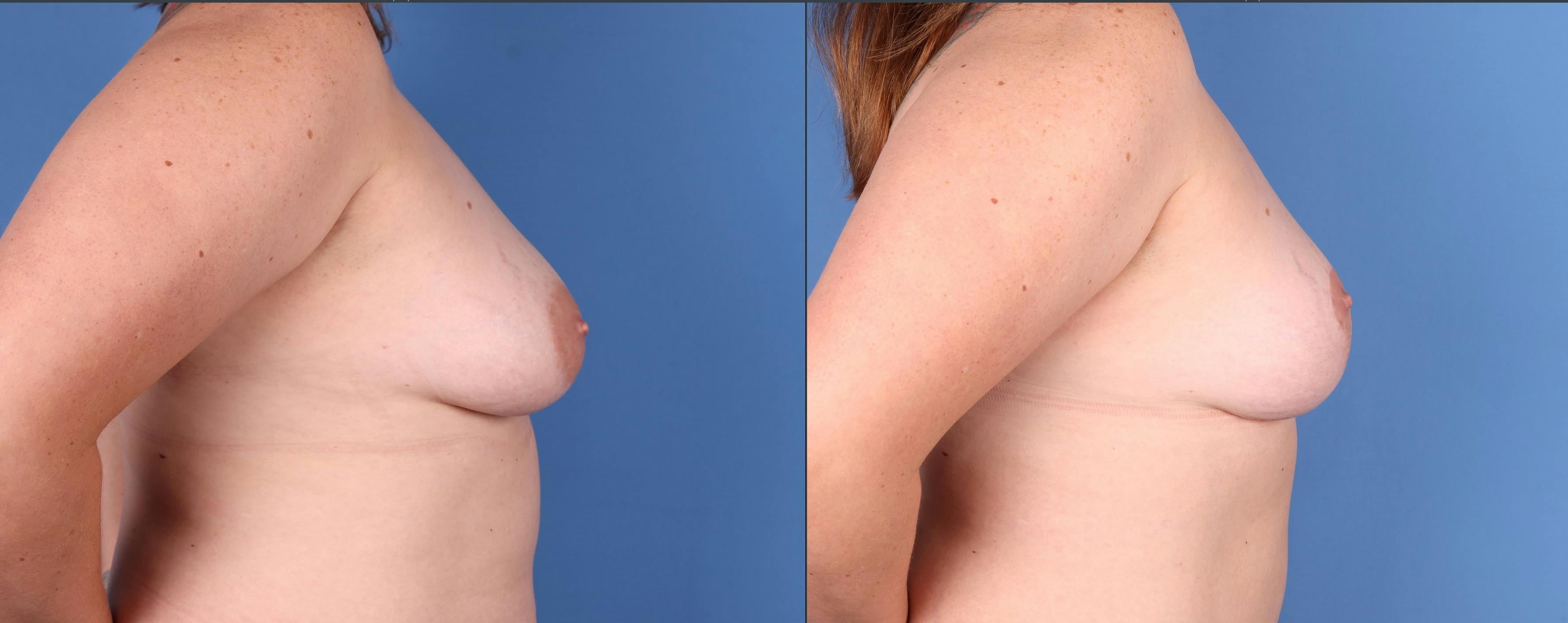 Breast Lift Before & After Gallery - Patient 144405666 - Image 3