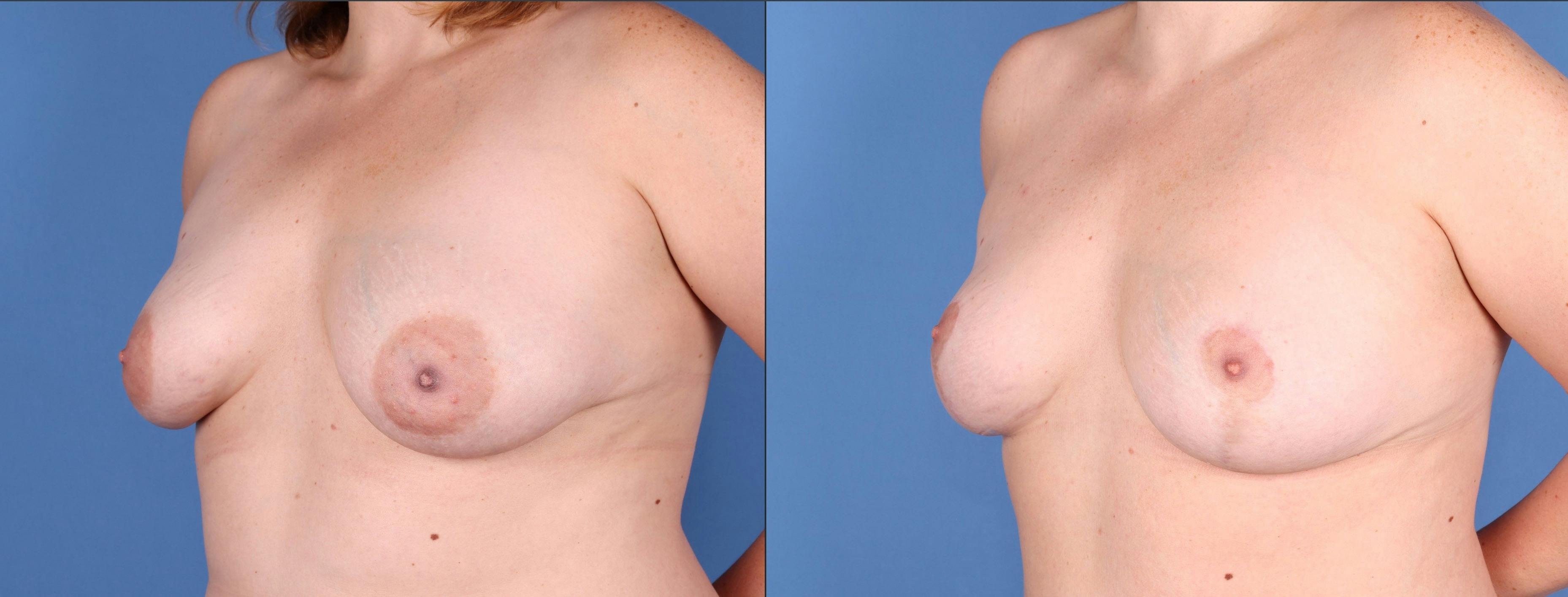 Breast Lift Before & After Gallery - Patient 144405666 - Image 4