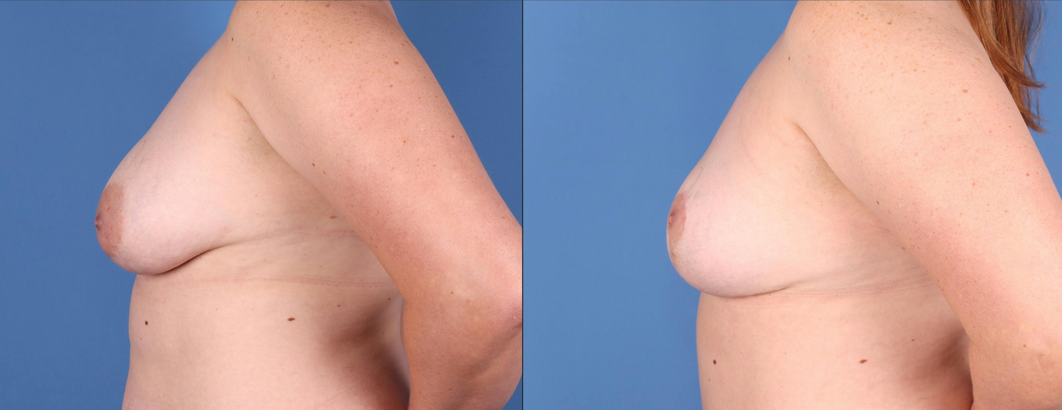 Breast Lift Before & After Gallery - Patient 144405666 - Image 5