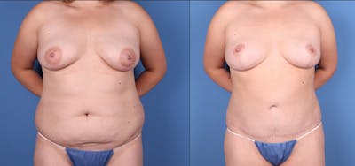 Mommy Makeover Before & After Gallery - Patient 122402660 - Image 1