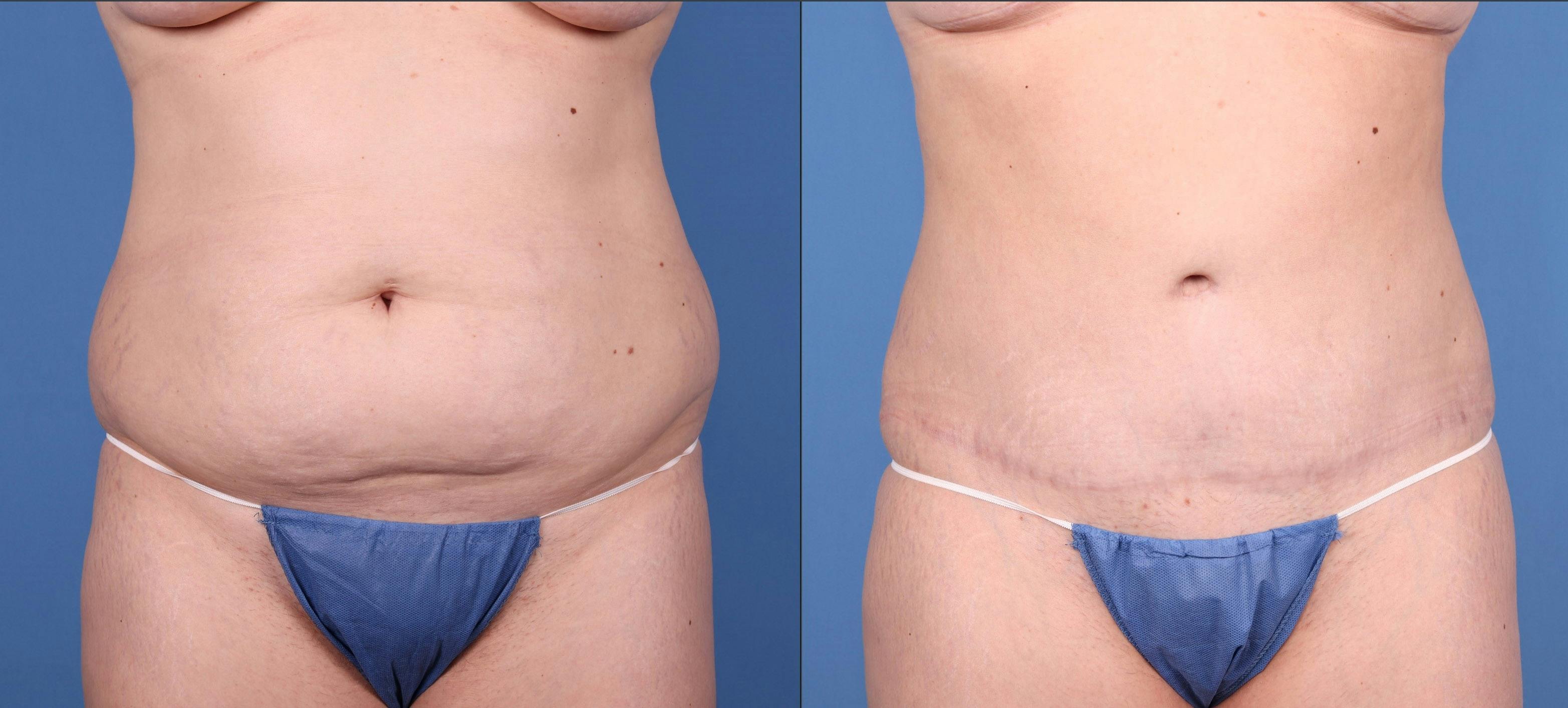 Tummy Tuck Before & After Gallery - Patient 144405665 - Image 1
