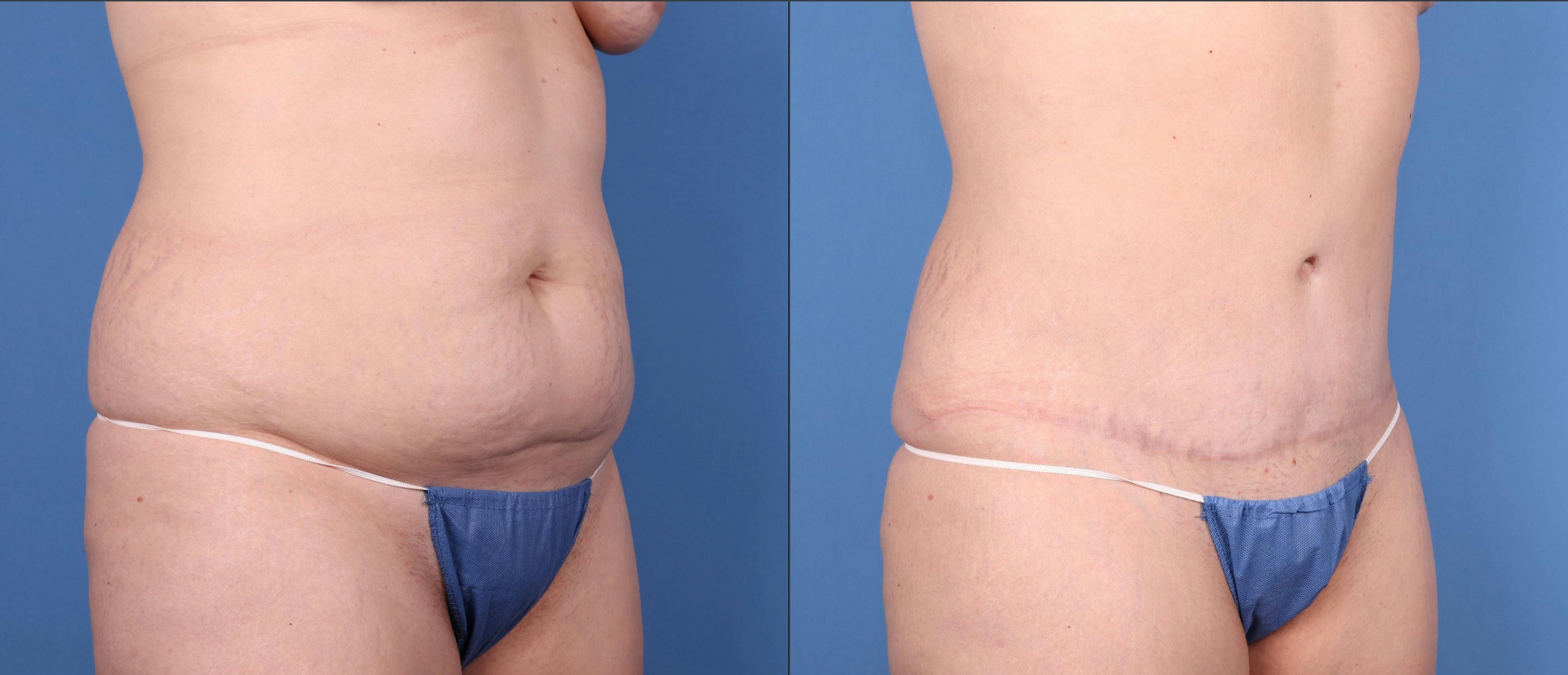 Tummy Tuck Before & After Gallery - Patient 144405665 - Image 2