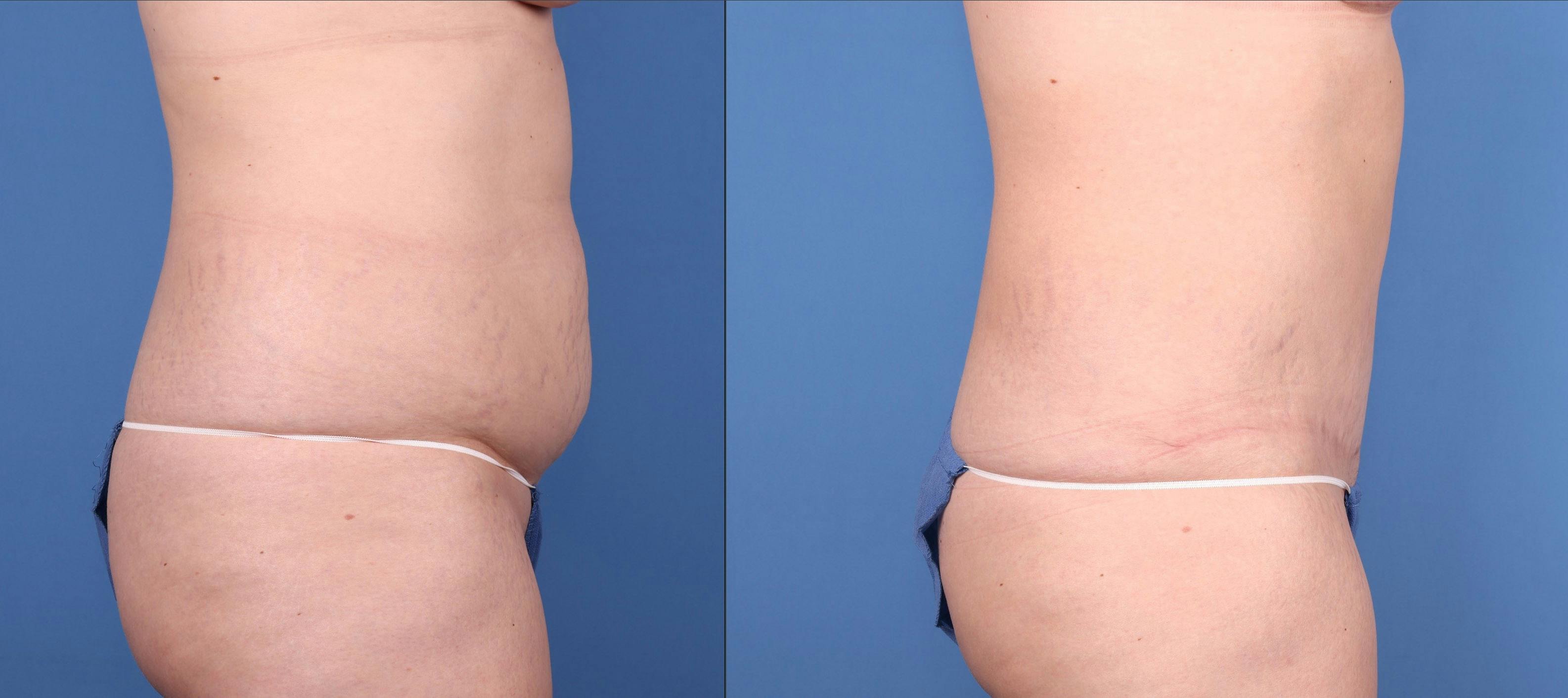 Tummy Tuck Before & After Gallery - Patient 144405665 - Image 3
