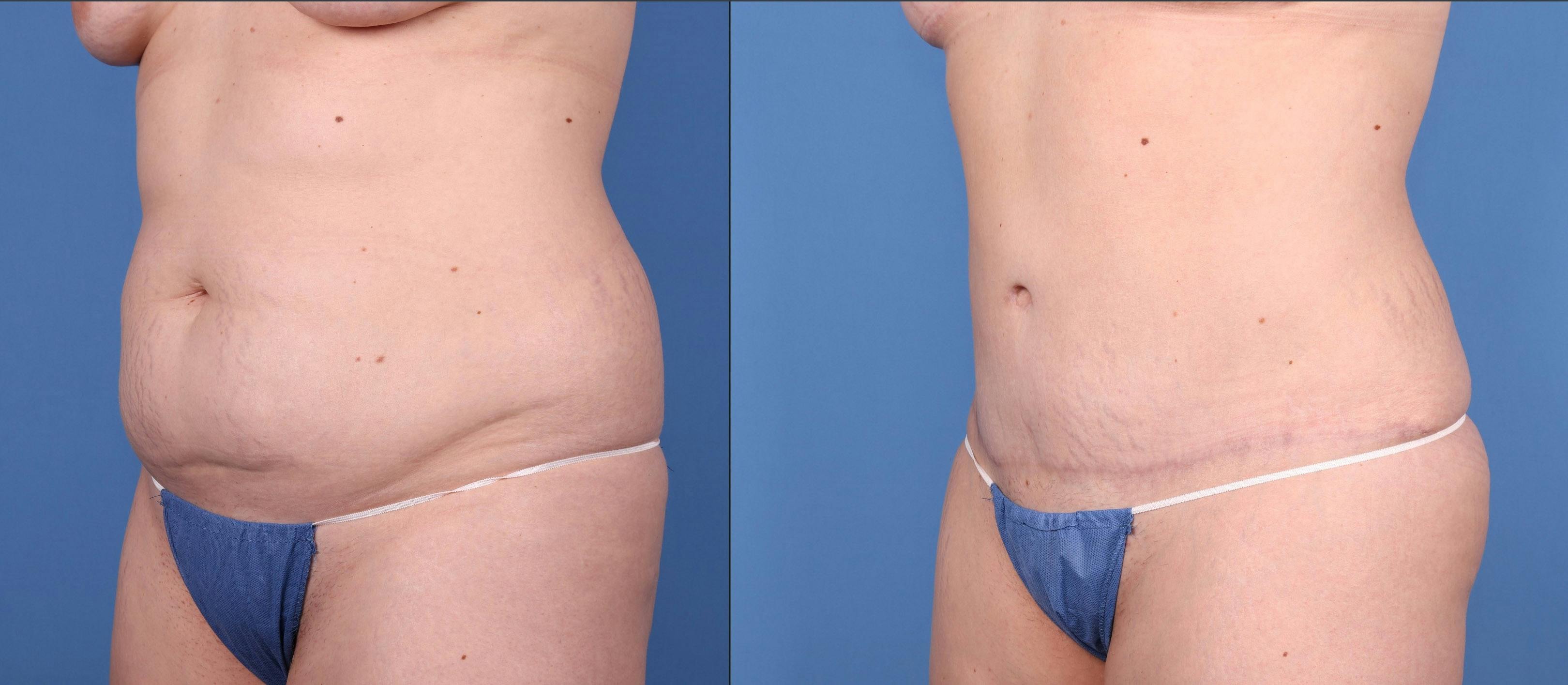 Tummy Tuck Before & After Gallery - Patient 144405665 - Image 4