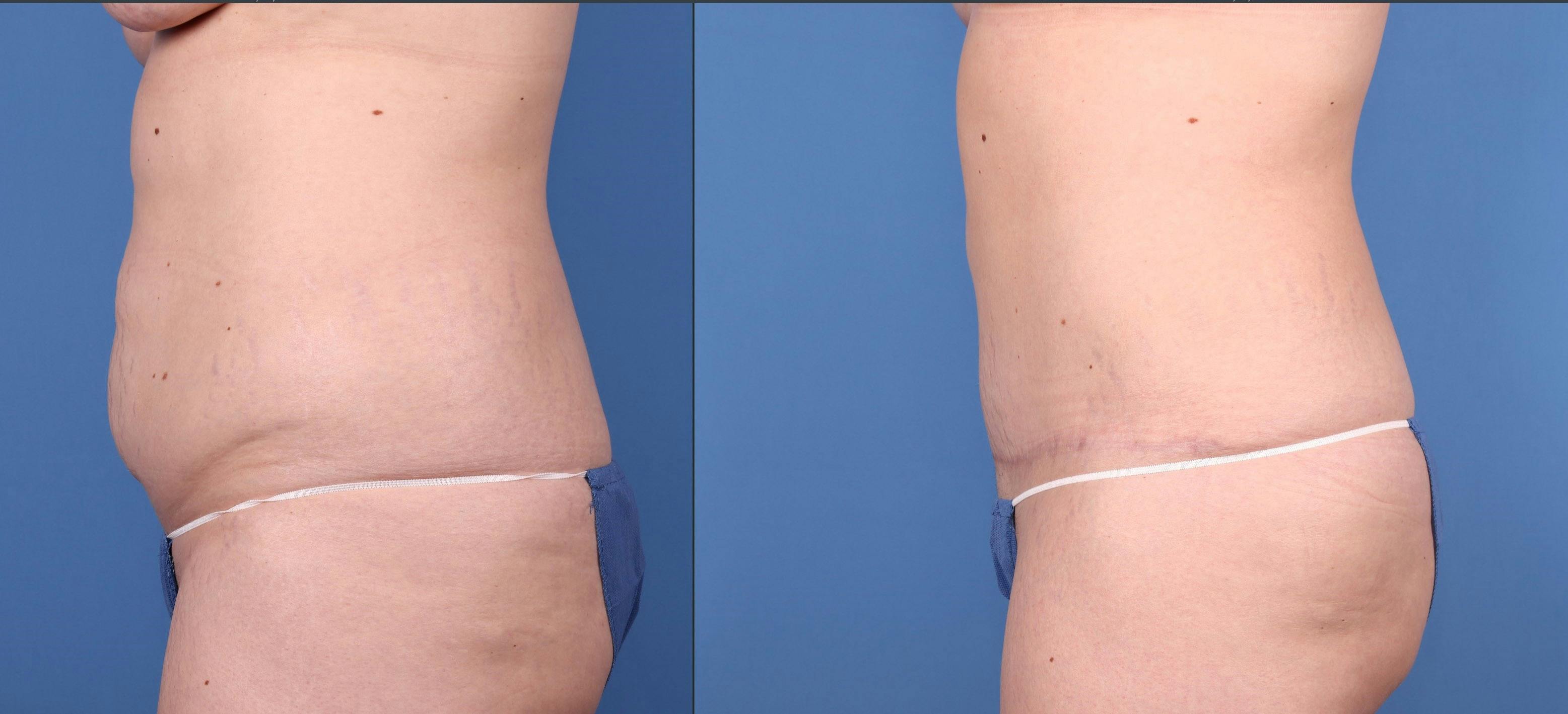 Tummy Tuck Before & After Gallery - Patient 144405665 - Image 5