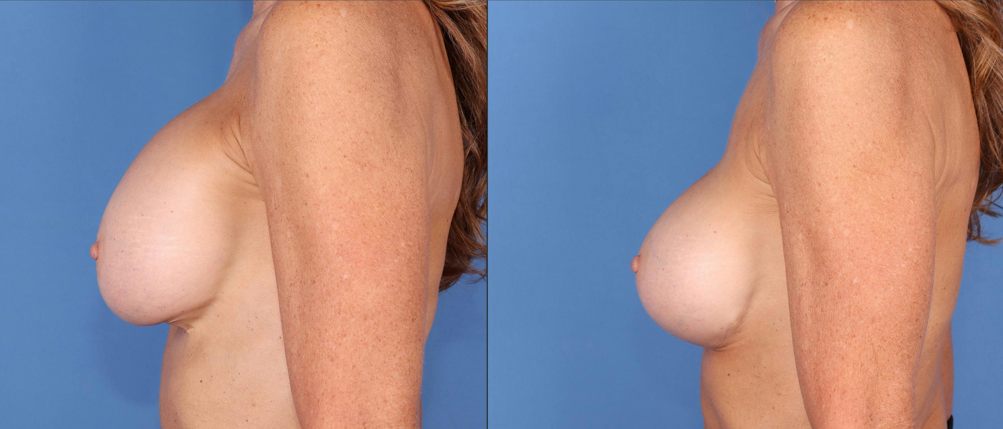Breast Revision Before & After Gallery - Patient 144405738 - Image 6