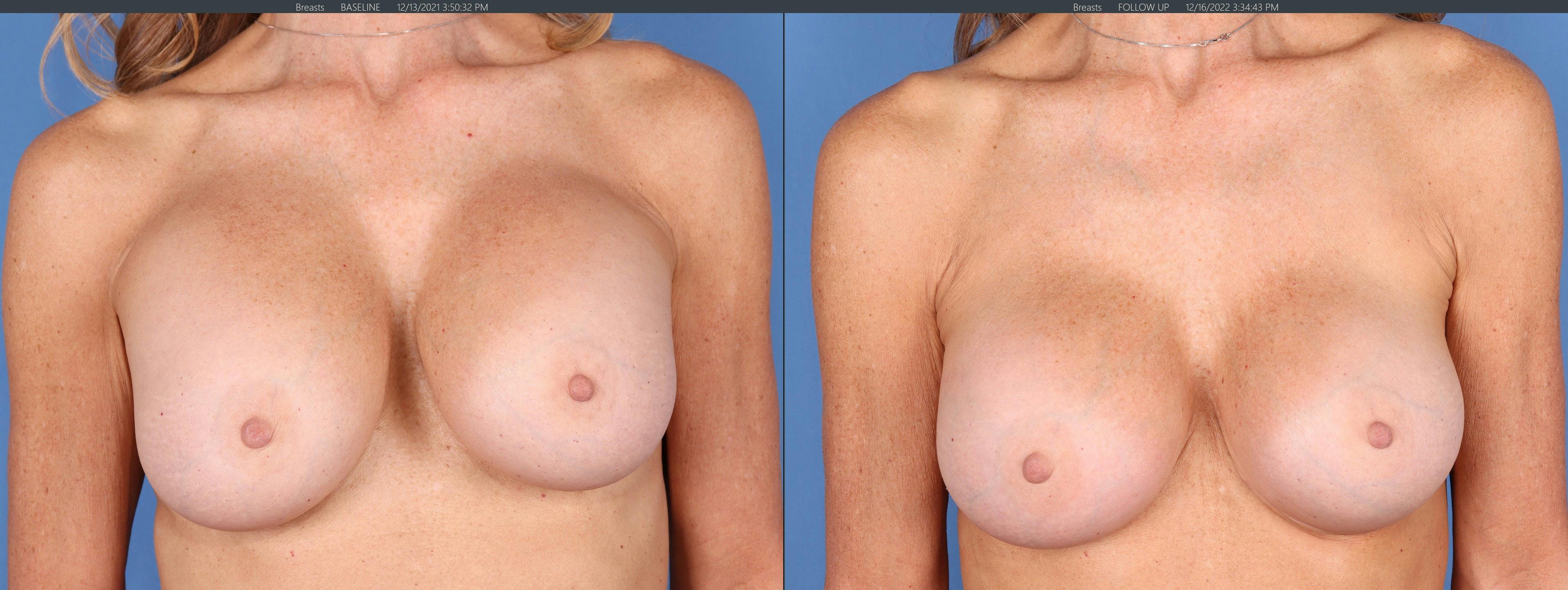 Breast Revision Before & After Gallery - Patient 144405738 - Image 1