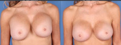 Breast Revision Before & After Gallery - Patient 144405738 - Image 1
