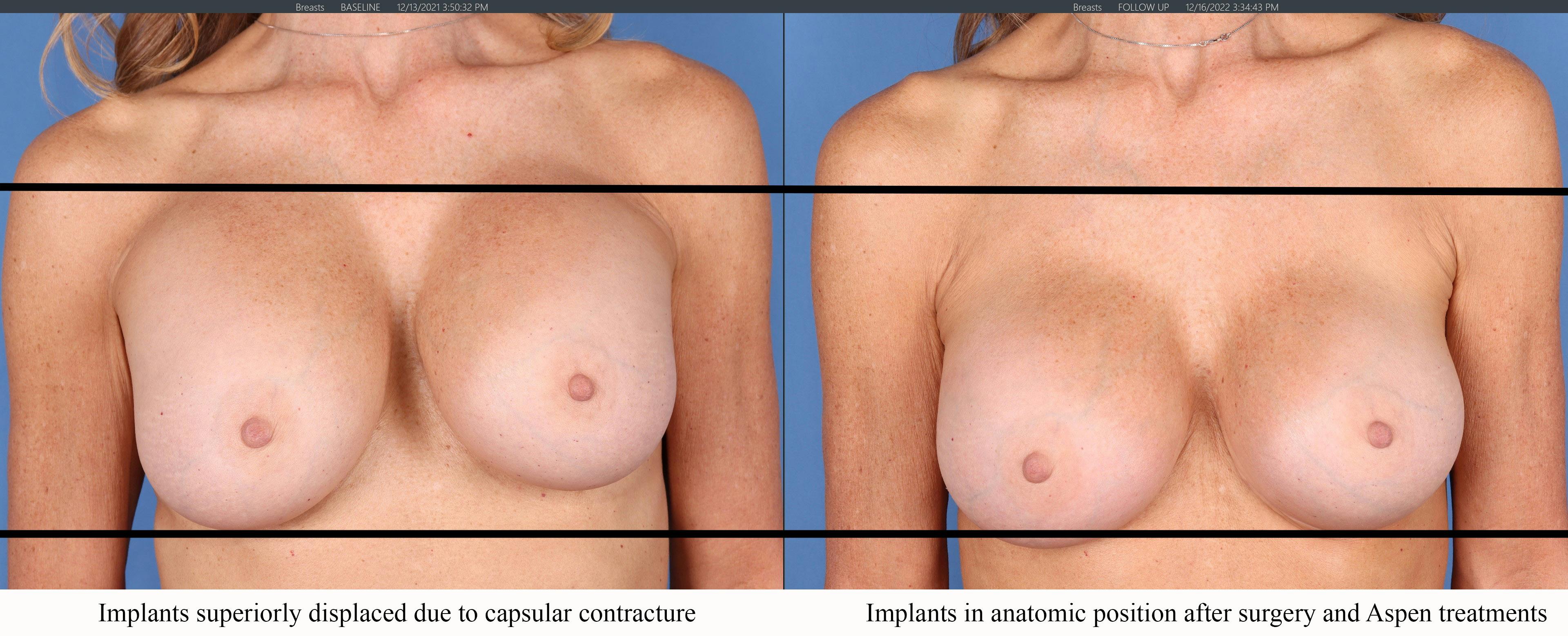 Breast Implant Revision Before & After Gallery - Patient 144405738 - Image 4