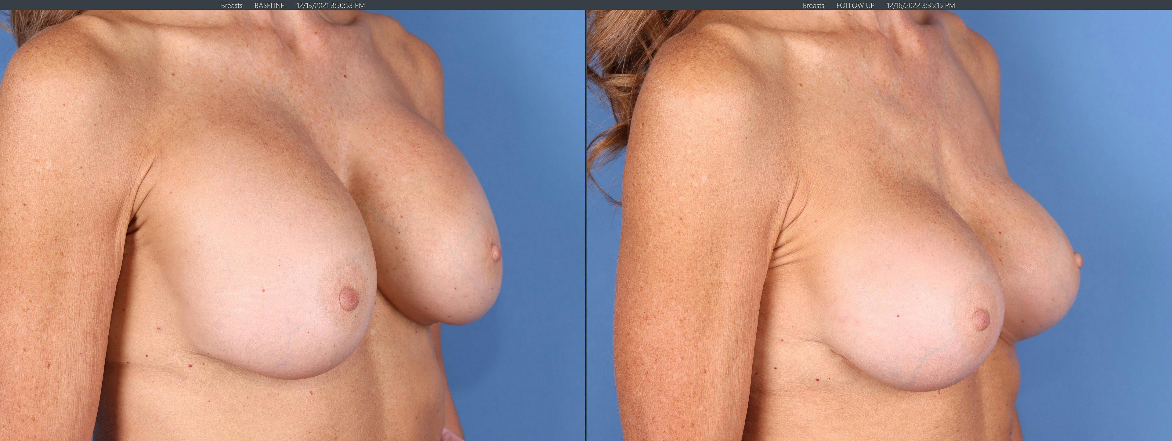 Breast Revision Before & After Gallery - Patient 144405738 - Image 2