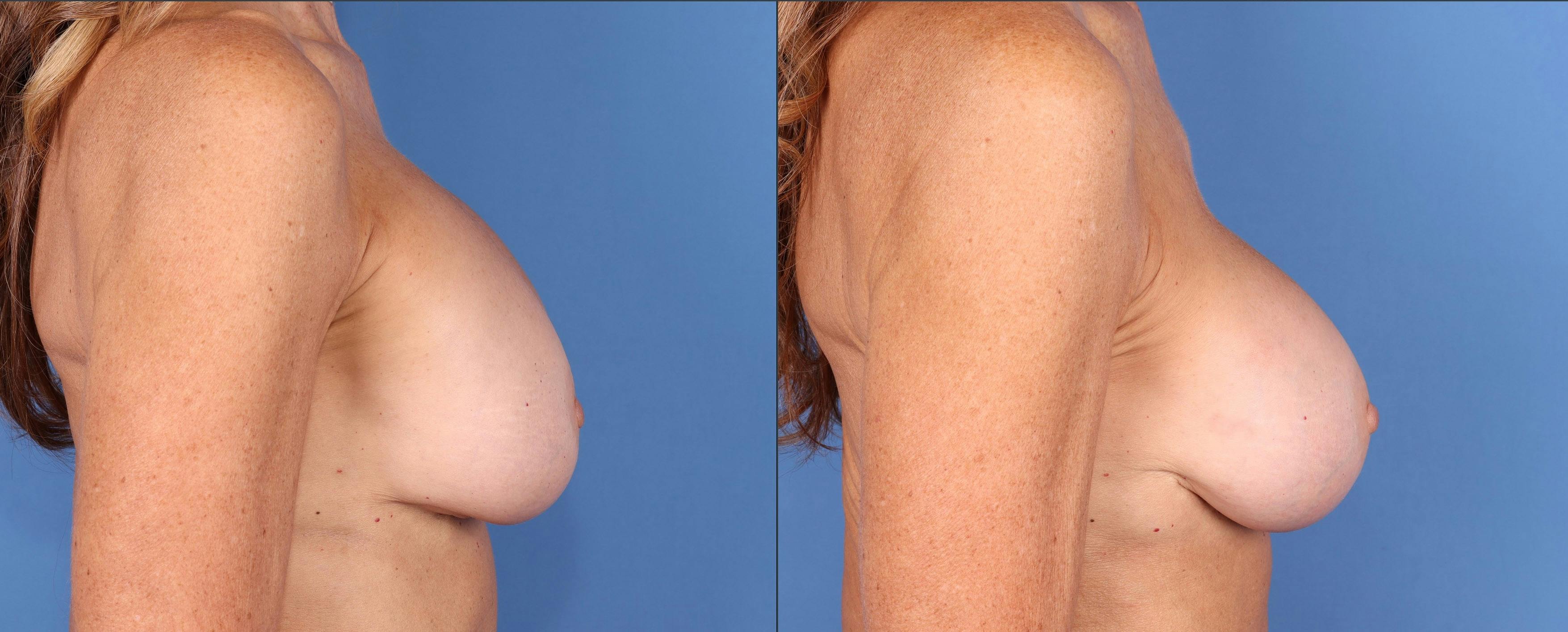 Breast Revision Before & After Gallery - Patient 144405738 - Image 3