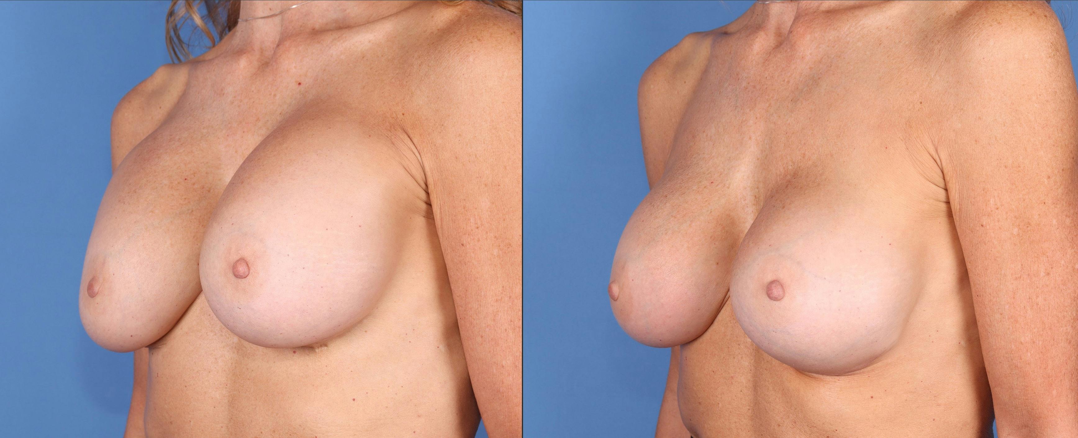 Breast Revision Before & After Gallery - Patient 144405738 - Image 5