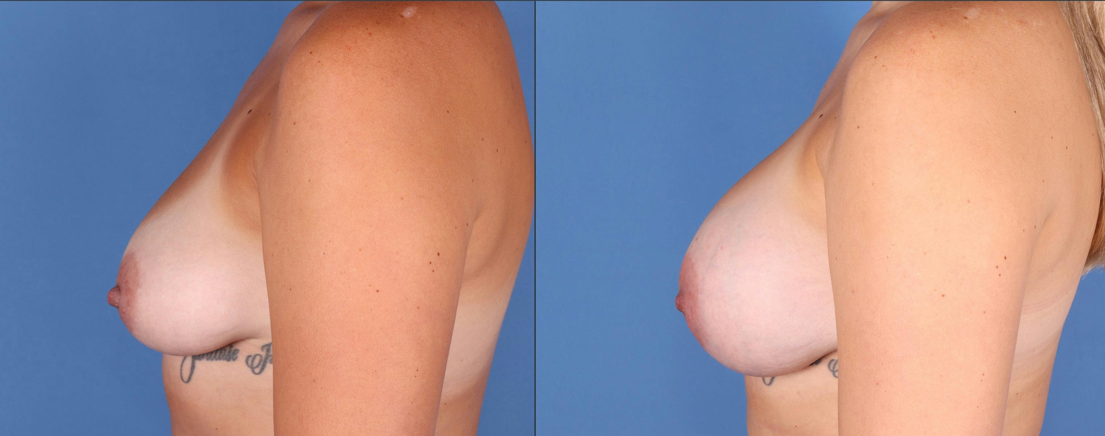 Breast Augmentation Before & After Gallery - Patient 144486449 - Image 5