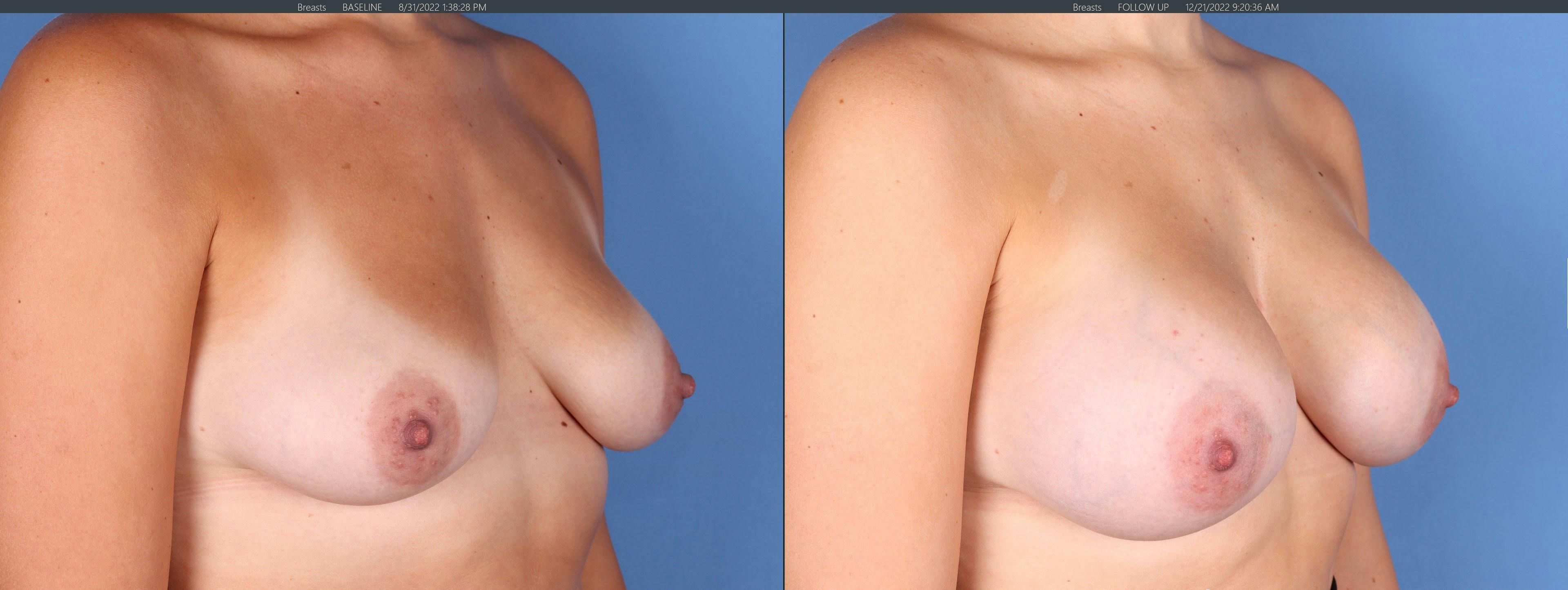 Breast Augmentation Before & After Gallery - Patient 144486449 - Image 2