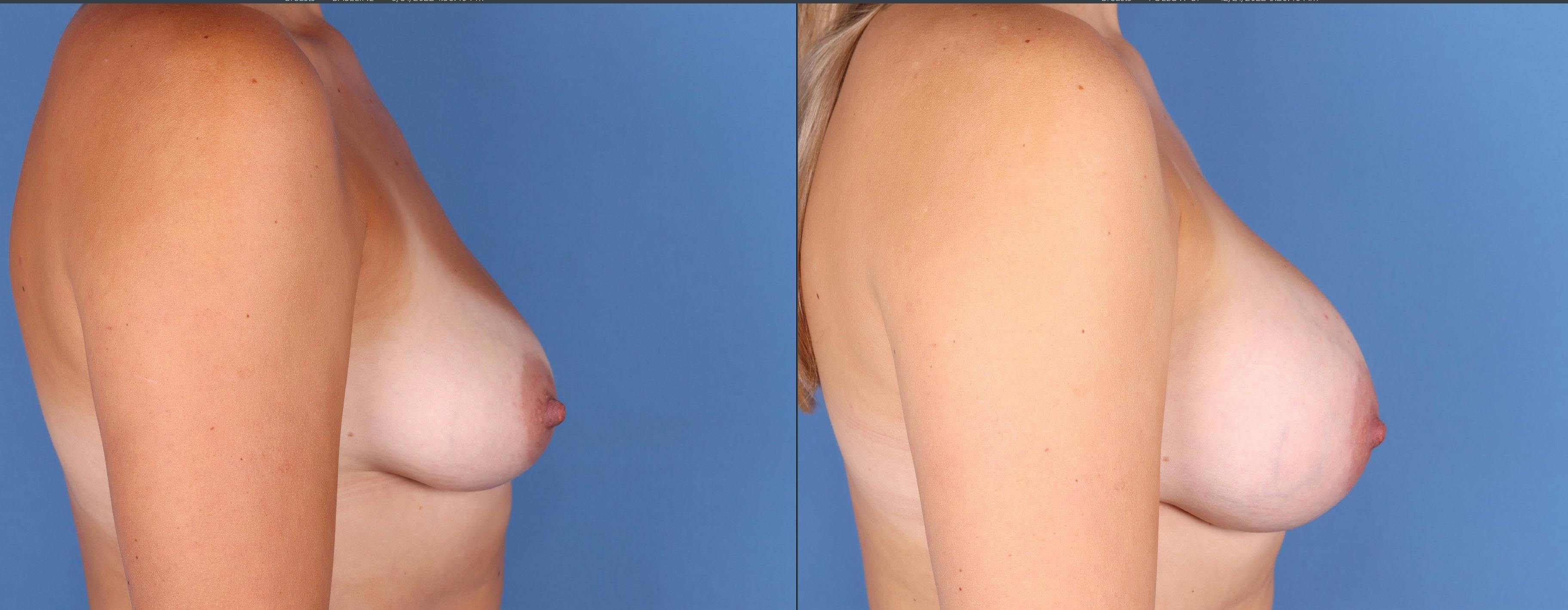 Breast Augmentation Before & After Gallery - Patient 144486449 - Image 3