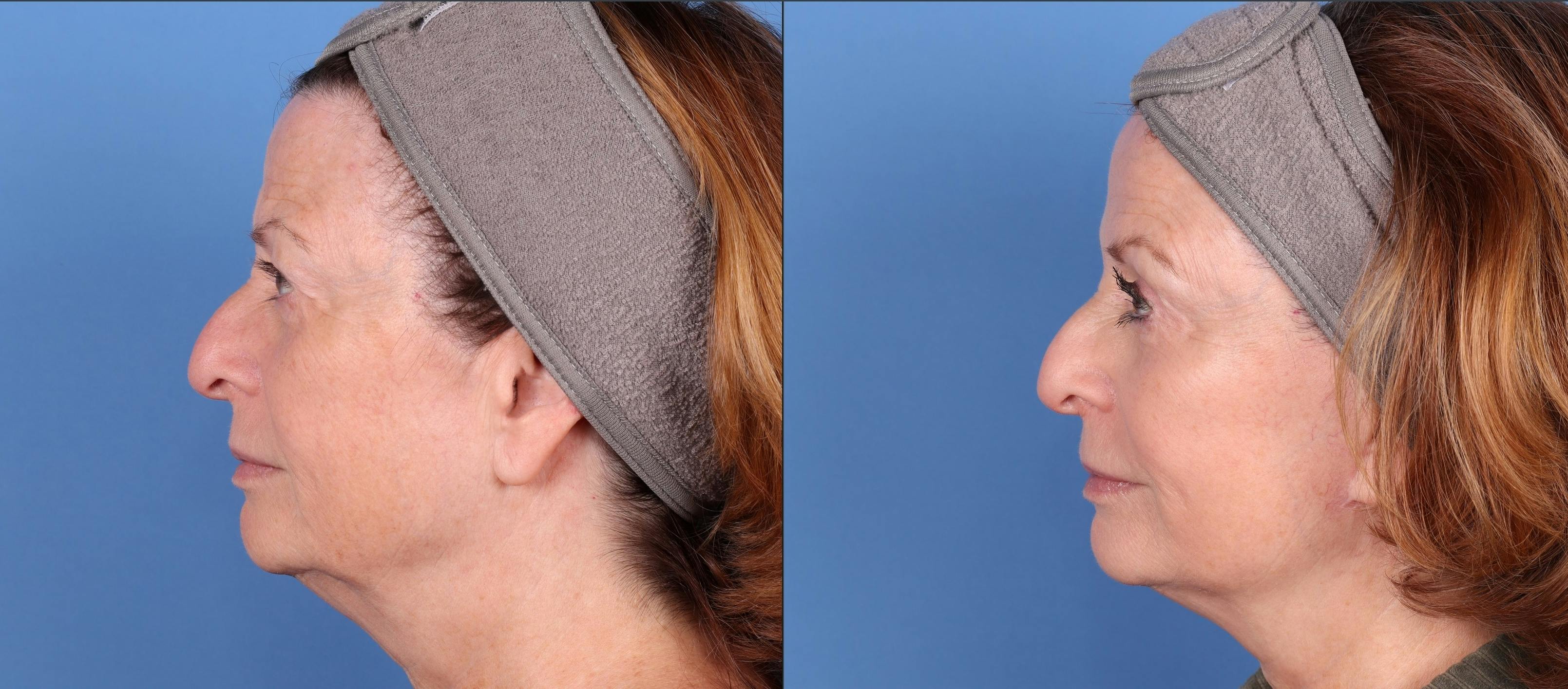 Face Lift Before & After Gallery - Patient 144486482 - Image 5