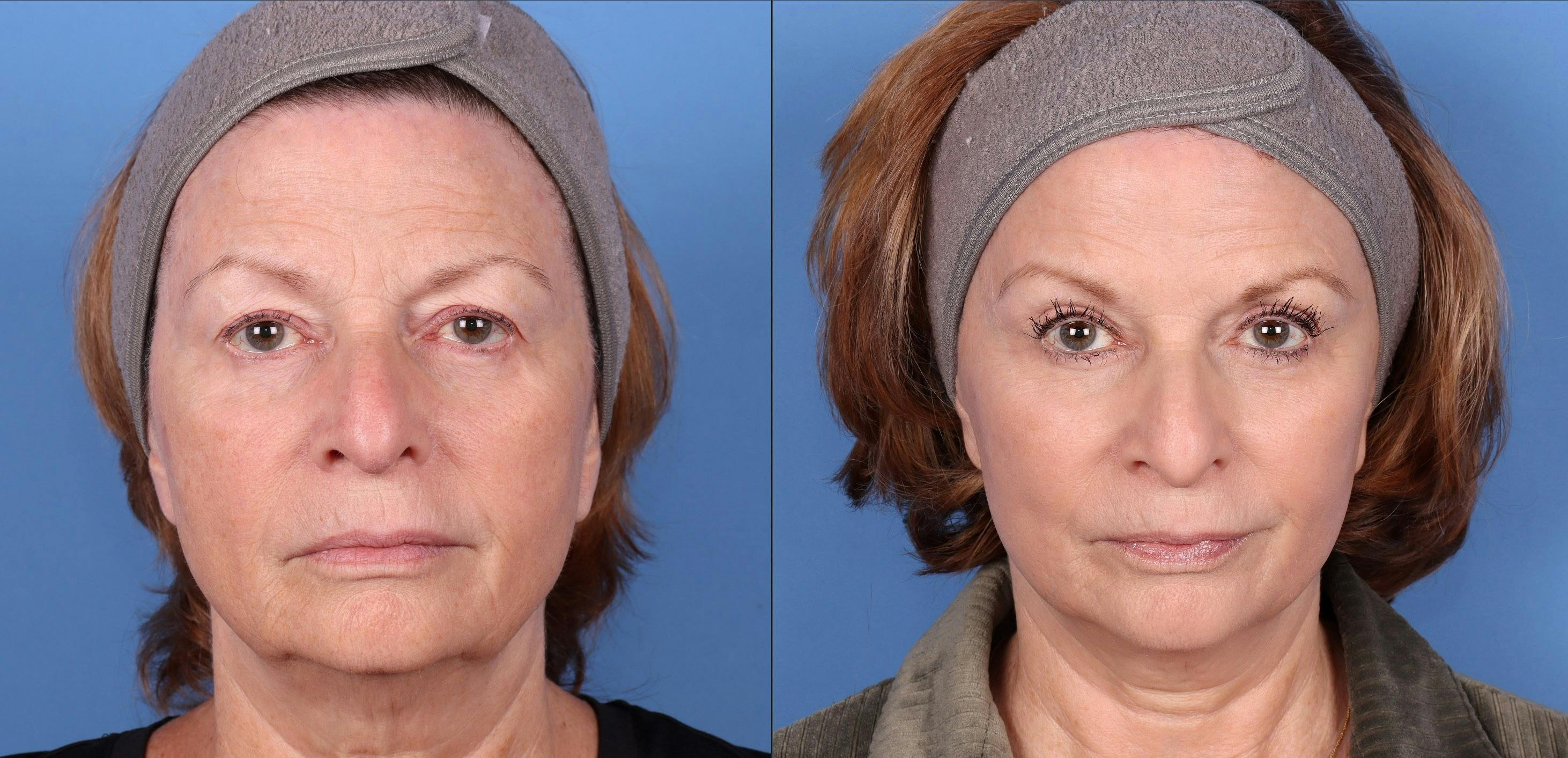Laser Treatments Before & After Gallery - Patient 144486484 - Image 1