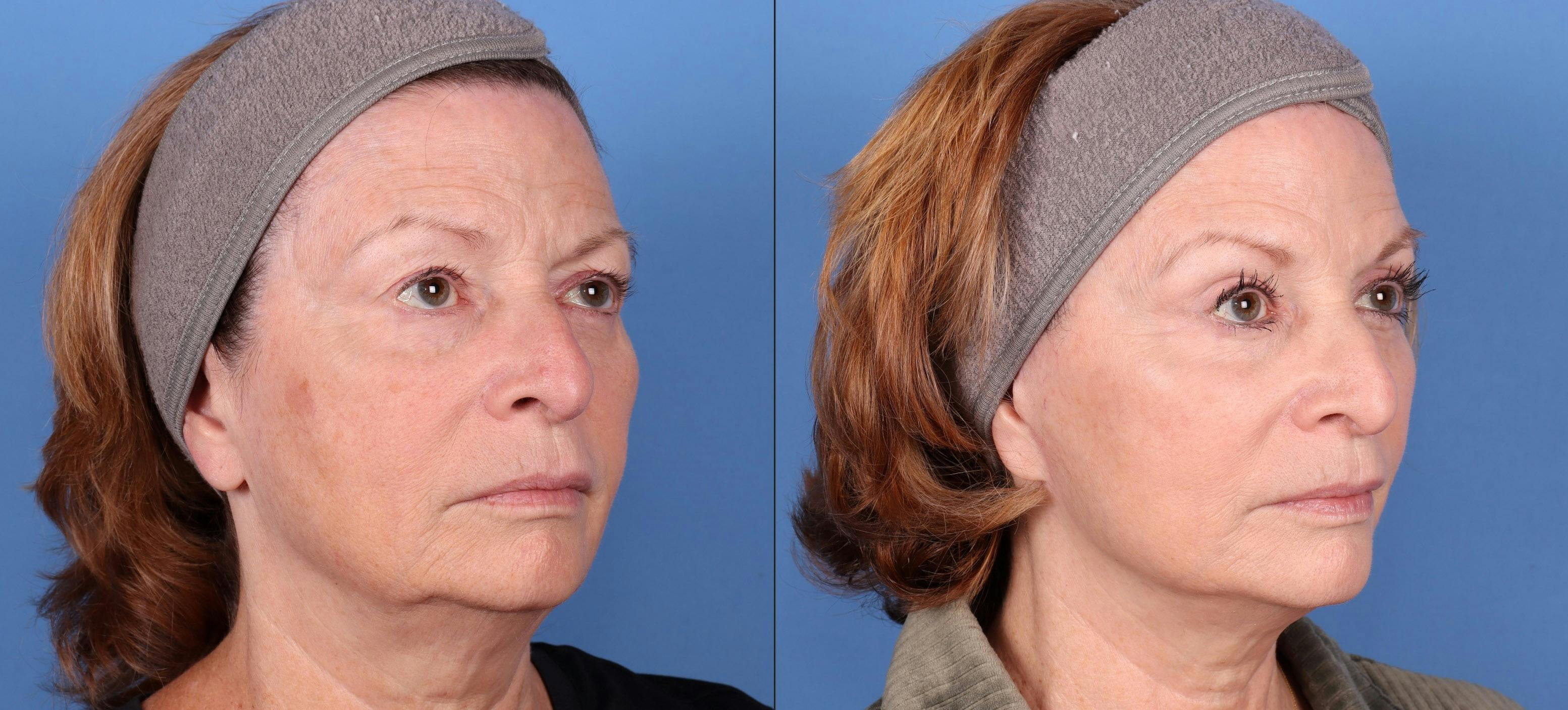 Eyelid Surgery (Blepharoplasty) Before & After Gallery - Patient 144486483 - Image 2