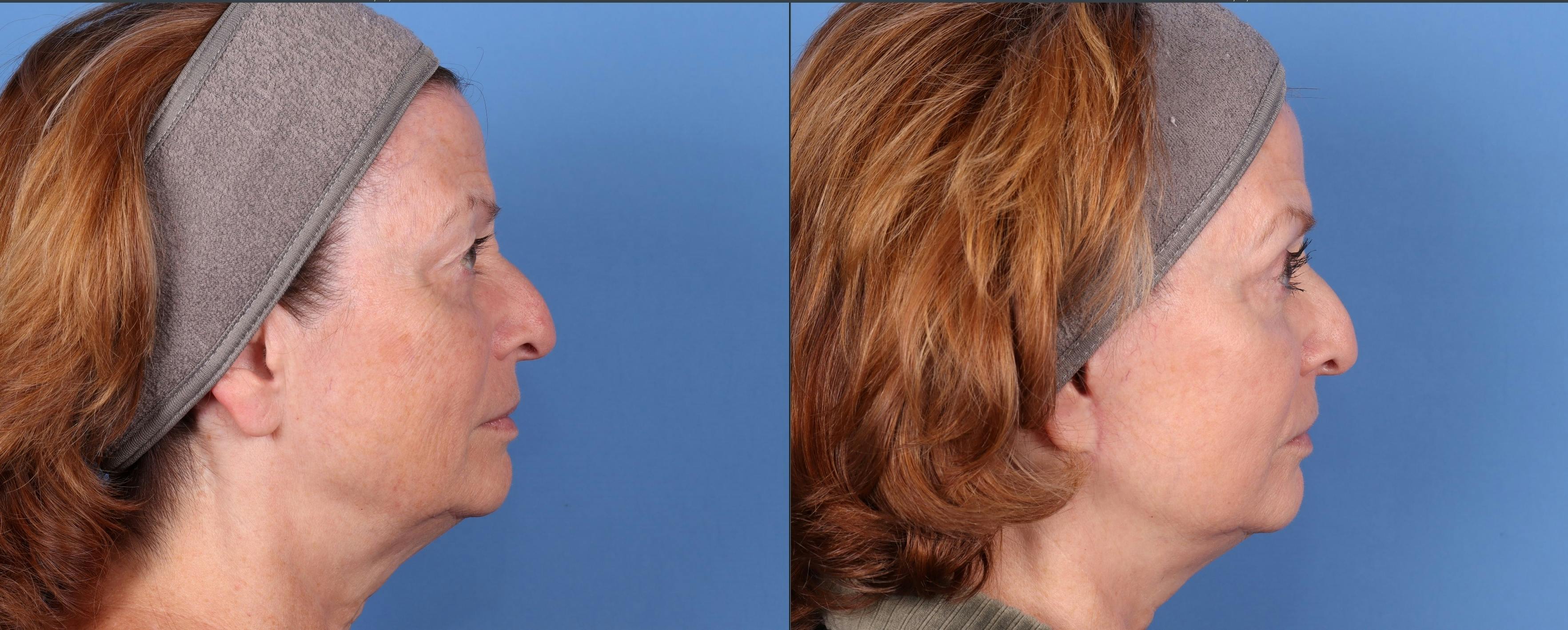 Eyelid Surgery (Blepharoplasty) Before & After Gallery - Patient 144486483 - Image 3