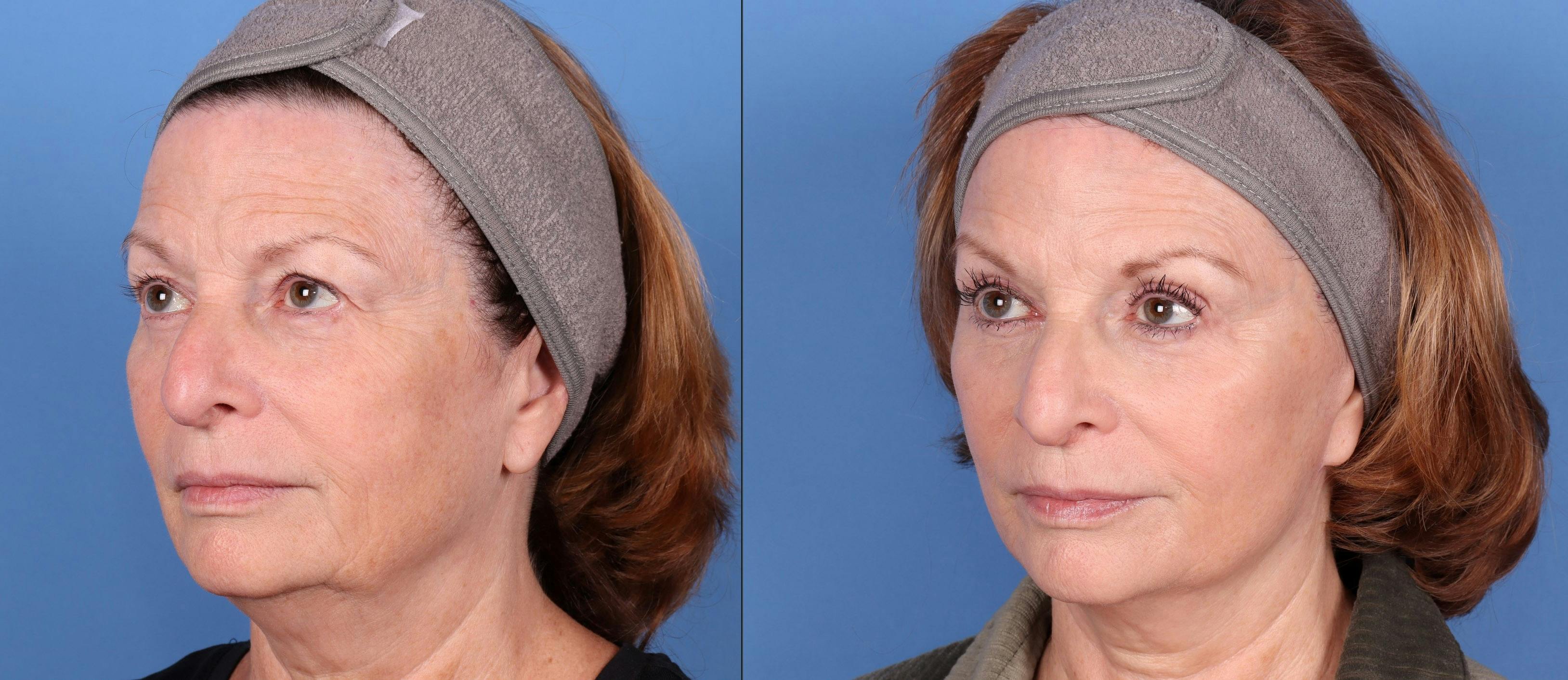 Eyelid Surgery (Blepharoplasty) Before & After Gallery - Patient 144486483 - Image 4