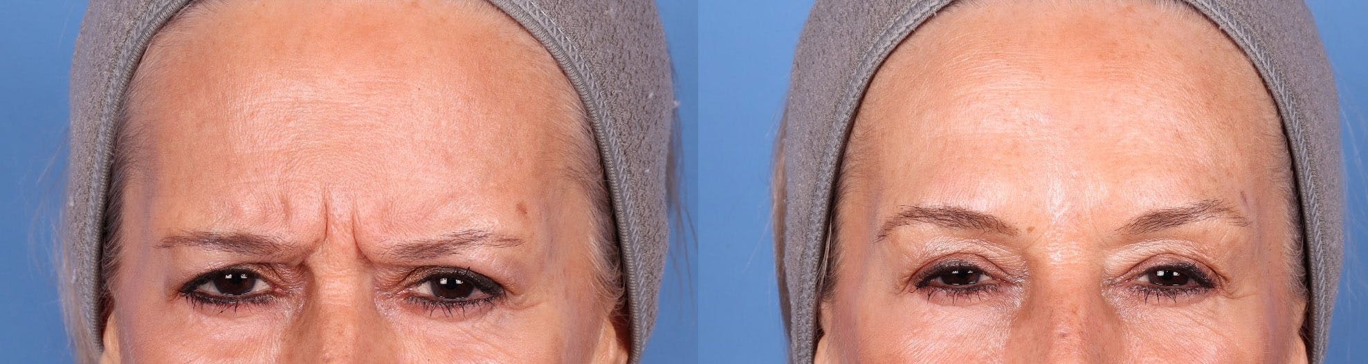 DAXXIFY Before & After Gallery - Patient 144945919 - Image 2