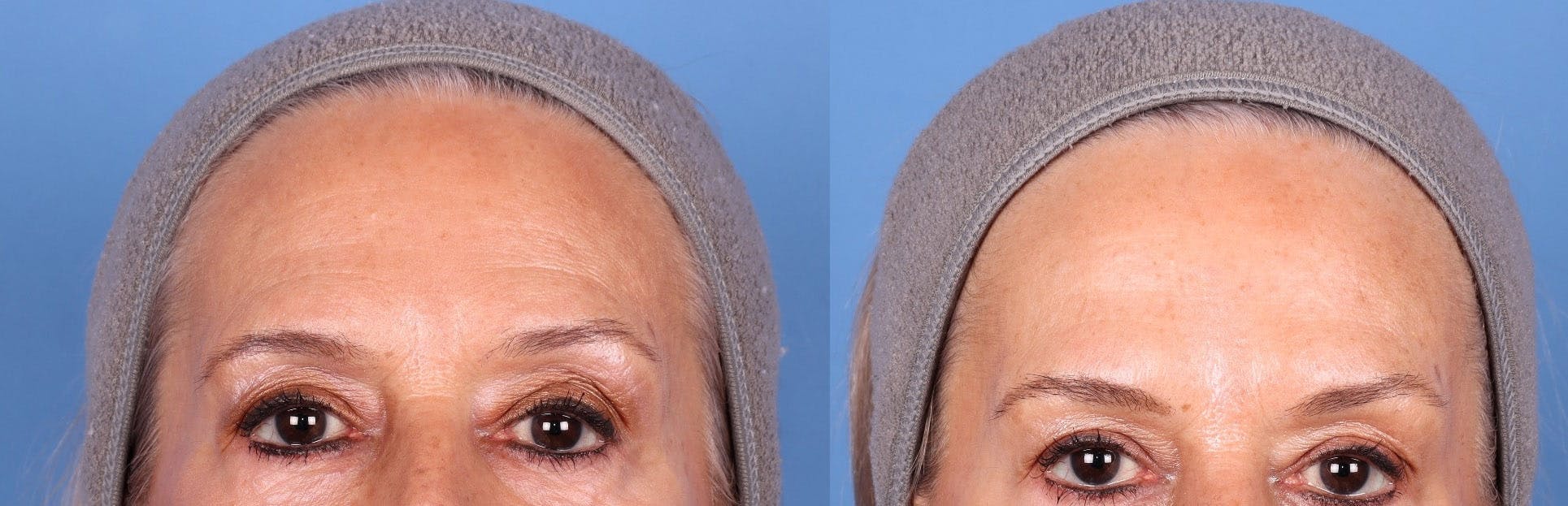 DAXXIFY Before & After Gallery - Patient 144945919 - Image 3