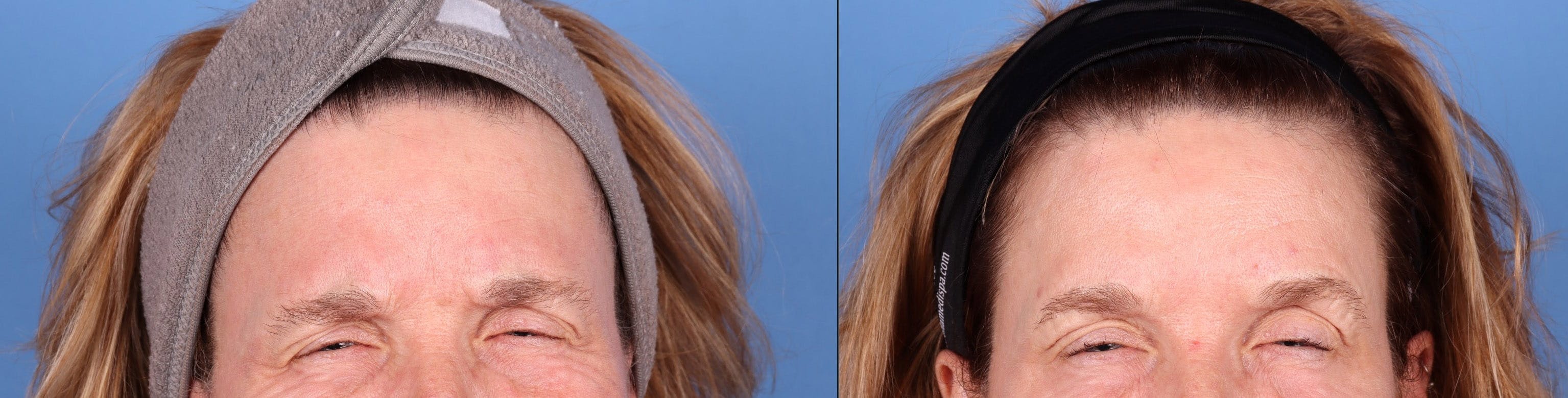 DAXXIFY Before & After Gallery - Patient 145105585 - Image 3