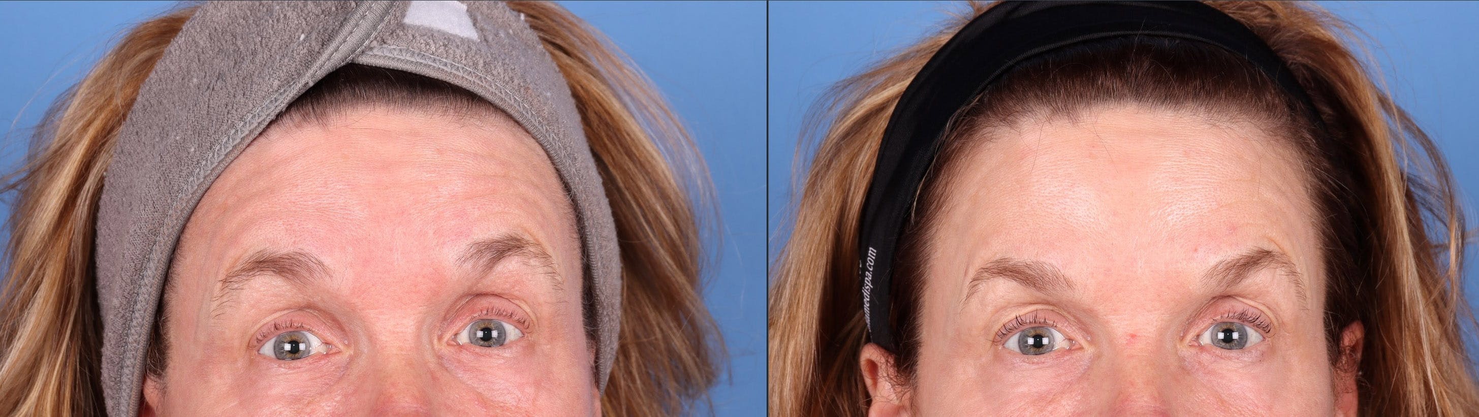 DAXXIFY Before & After Gallery - Patient 145105585 - Image 2