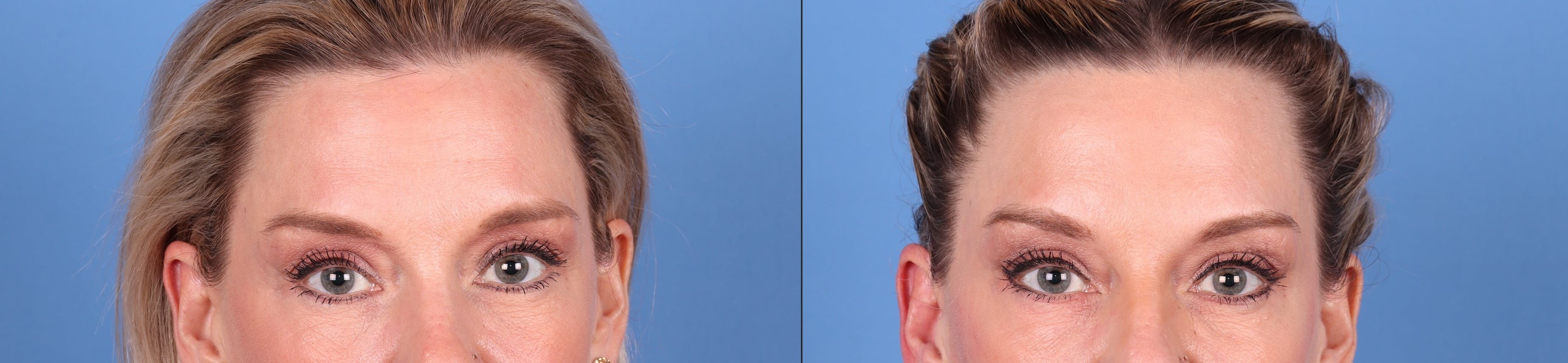 DAXXIFY Before & After Gallery - Patient 145105675 - Image 3