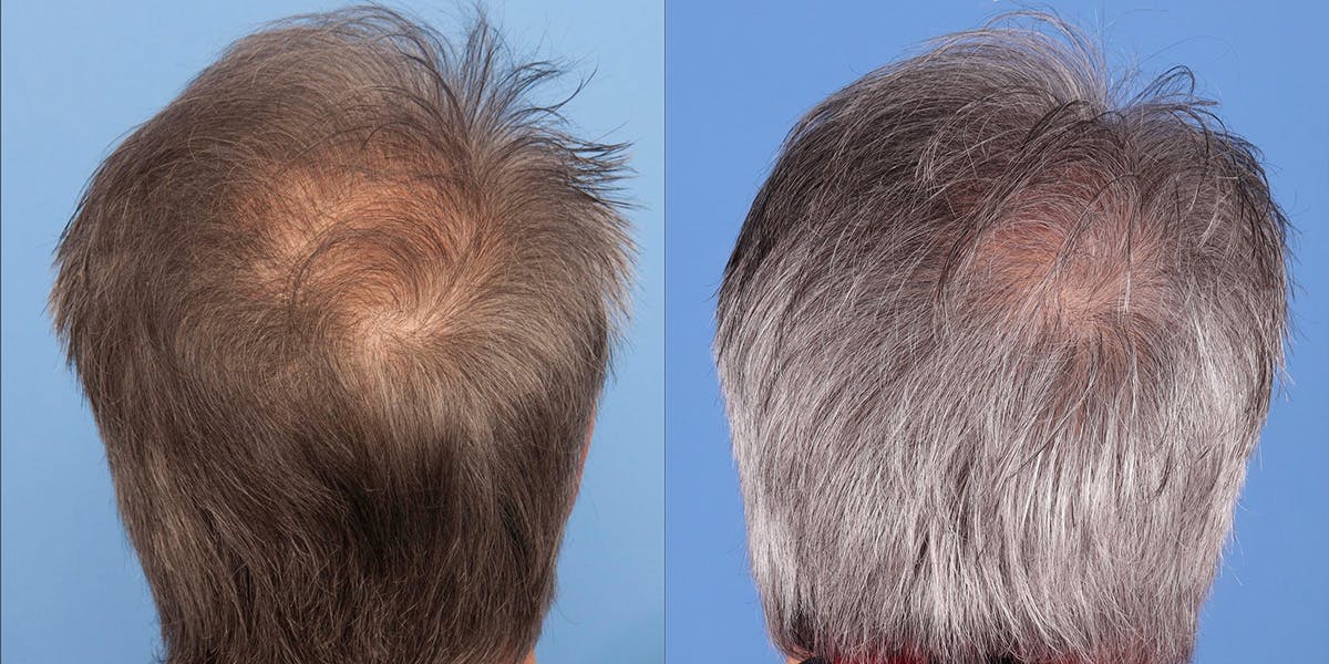 NeoGraft Hair Restoration Before & After Gallery - Patient 145833786 - Image 3