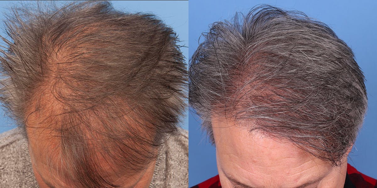 NeoGraft Hair Restoration Before & After Gallery - Patient 145833786 - Image 2