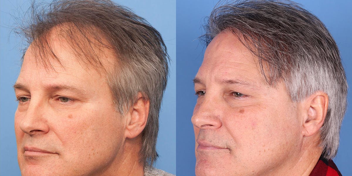 NeoGraft Hair Restoration Before & After Gallery - Patient 145833786 - Image 1