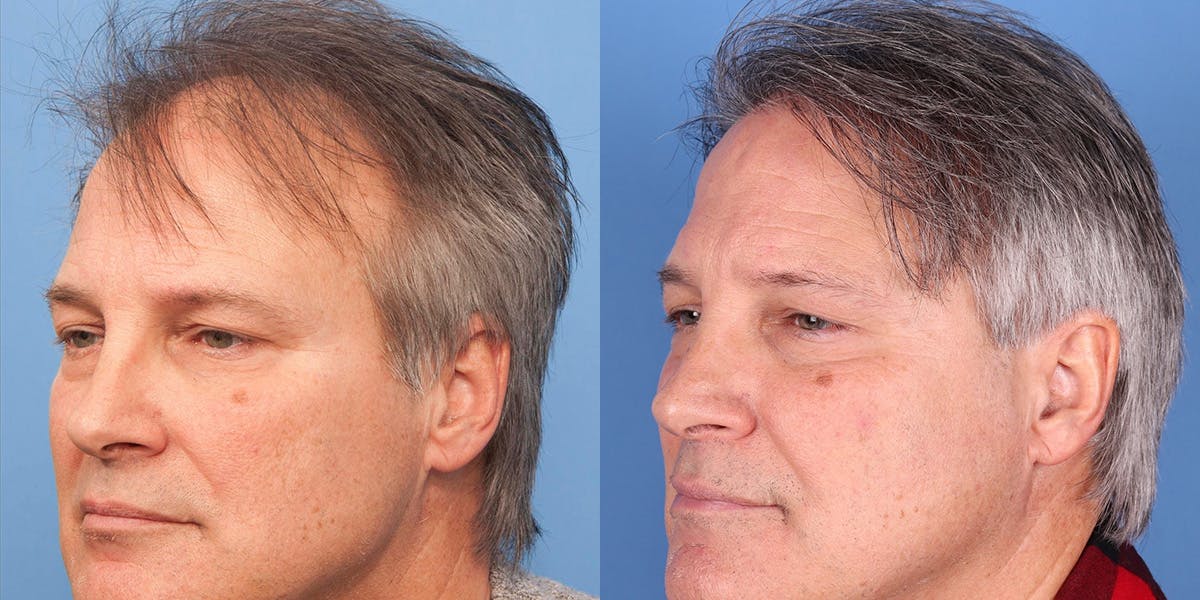 NeoGraft