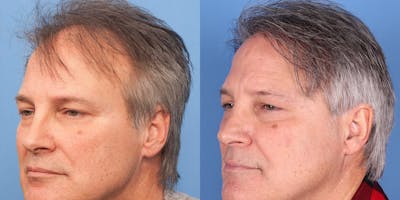 NeoGraft Hair Restoration Before & After Gallery - Patient 145833786 - Image 1