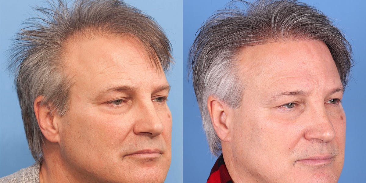 NeoGraft Hair Restoration Before & After Gallery - Patient 145833786 - Image 4
